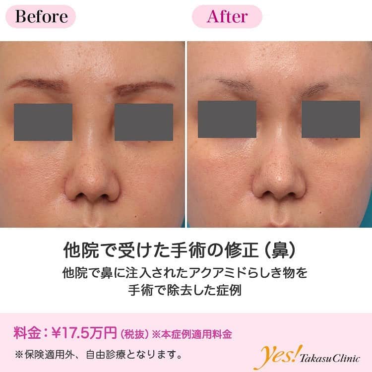 高須クリニックのインスタグラム：「👨🏻‍⚕️高須幹弥医師からのコメント✨⠀ 20代女性の患者様で、他院で鼻に注入物を入れ、除去希望で来院されました。 診察させていただいたところ、眉間から鼻根部、鼻背にかけてジェル状の物質が注入されており、横に広がって不自然に変形し、触るとブヨブヨしていました。 患者様本人は、「たしかアクアミドっていうものをいれられたと思う」とおっしゃっていました。 触診した感触では、確かにアクアミドのようなブヨブヨした不自然な感触だったのですが、アクアジェル、バイオアルカミド、エンドプラスト、エンドプロテーゼなどでも同じような感触になることがあるため、注入された物質が何なのかはっきりとはわかりませんでした。 ヒアルロン酸であればヒアルロニダーゼを注射して分解、溶解、吸収させることができるのですが、明らかにヒアルロン酸とは違う感触の注入物であるため、いずれにせよ手術で除去しなければならず、除去手術をすることになりました。 手術は局所麻酔注射し、右の鼻の穴の中を約8mm切開した後、剪刀で皮下を剥離し、エイヒで注入物を掻き出しました。 皮膚の浅い層に注入されている物は完全に取りきれませんでしたが、注入されていた内の8~9割くらいは除去することができました。 術後はほぼ元通りの鼻になり、不自然な印象はなくなりました。 ホームページやブログなどで常に警告していますが、鼻などにアクアミド、アクアジェル、バイオアクアミド、エンドプロテーゼ、エンドプラストなどの永久的な非吸収性注入物は絶対に注入してはいけません。 この患者様のように不自然になってしまう人、注入直後は大丈夫でも将来変形してしまう人が後をたちません。 ---------------------------------------------------- 🌈料金✨⠀ ●他院で受けた手術の修正（鼻） （本症例適用料金） ¥175,000【東京、横浜、名古屋、大阪】 ※診察にてご確認ください ---------------------------------------------------- ⚠️リスク・副作用・合併症✨⠀ ●他院で受けた手術の修正（鼻） 手術後に処方する抗生剤や痛みどめによるアレルギー症状 --------------------------------------------------- 😊施術についての詳細✨⠀⠀ https://www.takasu.co.jp/photo/nose_modify06.html ---------------------------------------------------- 📞ご予約・お問い合わせ✨⠀ 0120-5587-10⠀ https://www.takasu.co.jp/cgi-bin/form/contact.cgi ※症例写真や施術に関するご質問なども上記までお願い致します。 ---------------------------------------------------- #他院で受けた手術の修正 #鼻の注入物を除去 #鼻修正 #鼻整形  #皮膚 #美容 #美肌 #エイジングケア #美容整形 #美容外科 #美容クリニック #美容好き #美容皮膚科 #モニター #モニター募集 #高須クリニック #高須クリニック名古屋 #高須幹弥 #整形したい #プチ整形 #症例 #症例写真 #可愛くなりたい #可愛い #美人」