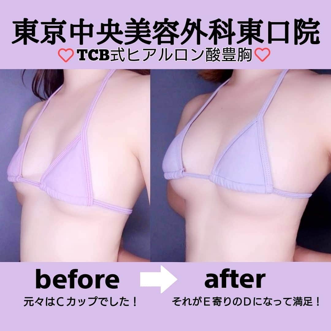のインスタグラム：「たくさんのDMありがとうございます🥺 やっぱりbefore afterのお写真が見たい と言うお声があったので🙋🏼‍♀️❤ . 東京中央美容外科東口院のまりこ先生 @drinouemariko ♡ に #tcb式ヒアルロン酸豊胸 して貰った before➡afterになります🥺❤ . ボリューム増したし、 見た目も綺麗になったから本当に受けて 良かった施術です😚 すごく女性にとってデリケートなお話に なるけど、 私は施術してよかったと思ってる🥺 あとタイトなニット着るとやっぱり あー！大きくなったなと実感😚笑 . 引き続き悩んでる方DM何でも下さい🥰 力になりたいです！💭 . @tcbmariko_shorei  ここでたくさん症例が見れます🤍 #豊胸ならtcb東京中央美容外科 #美容整形ならtcb東京中央美容外科 #豊胸なら井上真梨子医師 #東京中央美容外科 #美容外科 #池袋東口院 #東京中央美容外科池袋東口院 #井上真梨子 #まりこ先生 #バストアップ #PR」