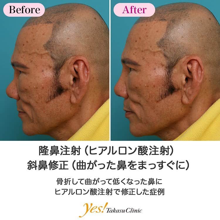 高須クリニックのインスタグラム：「👨🏻‍⚕️高須幹弥医師からのコメント✨⠀ 昔、ボクシングで鼻を殴られ、鼻骨が骨折して、潰れて低くなってしまった上に、左に曲がってしまってます。 長期持続型のヒアルロン酸を曲がっている部分に1本（1cc）注入し、なるべくまっすぐに修正した上に、高さもだしました。 当院の長期持続型のヒアルロン酸は注入する量にもよりますが、4~6年くらいかけてゆっくりと吸収されてなくなっていきます。 こういうケースは土台が曲がっているため、完全なまっすぐにすることは難しいですが、注射だけでもかなりまっすぐに修正することができます。 もし、この方に注射以外の方法で治すとなると、まず、鼻骨骨切り手術をして鼻をまっすぐにして、3ヶ月以上待って骨が固まってから、シリコンプロテーゼあるいは自家骨移植をして高さを出します。 どちらを選択するかは、術前のカウンセリングで決めます。 ---------------------------------------------------- 🌈料金✨⠀ ●斜鼻修正（曲がった鼻をまっすぐに） 斜鼻修正　手術 ¥600,000【東京、横浜、名古屋、大阪】 / シリコンプロテーゼ挿入 ¥350,000【東京、横浜、名古屋、大阪】 / ヒアルロン酸 ¥50,000【全院】 / 長期持続型ヒアルロン酸 ¥150,000【全院】 ---------------------------------------------------- ⚠️リスク・副作用・合併症✨⠀ ●斜鼻修正（曲がった鼻をまっすぐに） 鼻ギプスがマスクで隠しきれない／目や鼻周辺の腫れ（術後） 目や鼻周辺の腫れ・内出血（術後） 内出血（注射針が血管に当たってしまった場合） 仕上がりのわずかな左右差（完璧なシンメトリーは不可） 過度にいじったり揉んだりすると腫れる可能性 --------------------------------------------------- 😊施術についての詳細✨⠀⠀ https://www.takasu.co.jp/photo/shabi02.html ---------------------------------------------------- 📞ご予約・お問い合わせ✨⠀ 0120-5587-10⠀ https://www.takasu.co.jp/cgi-bin/form/contact.cgi ※症例写真や施術に関するご質問なども上記までお願い致します。 ---------------------------------------------------- #隆鼻注射 #ヒアルロン酸注射 #斜鼻修正 #曲がった鼻をまっすぐに #鼻修正 #皮膚 #美容 #美肌 #エイジングケア #美容整形 #美容外科 #美容クリニック #美容好き #美容皮膚科 #モニター #モニター募集 #高須クリニック #高須クリニック名古屋 #高須幹弥 #整形したい #プチ整形 #症例 #症例写真 #可愛くなりたい #可愛い #美人」