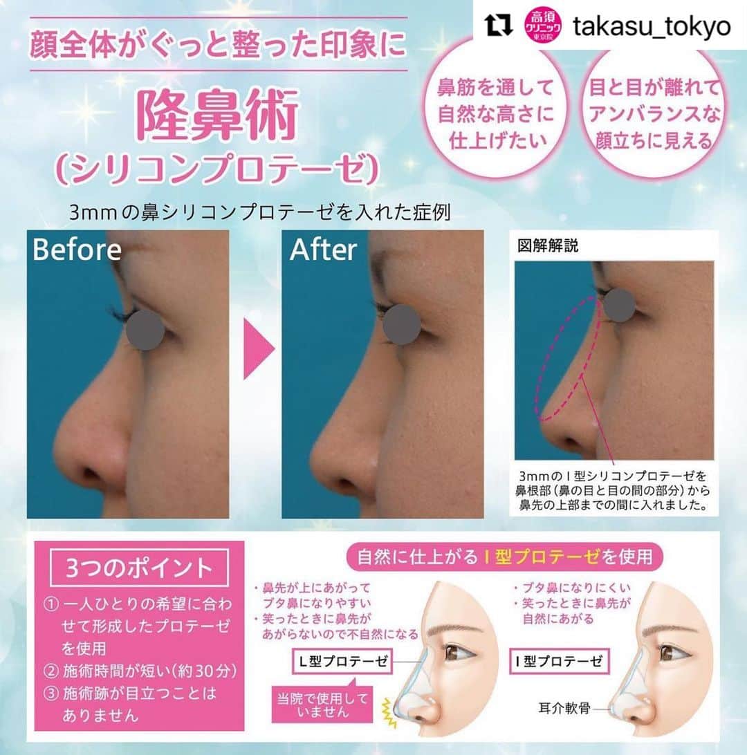 高須クリニックのインスタグラム：「. ━･･━･･━･･━･･━･･━･･━ #Repost @takasu_tokyo ━･･━･･━･･━･･━･･━･･━ 3mmの鼻シリコンプロテーゼを入れた症例﻿ ﻿ 20代の女性の患者様で、この方は以前に鼻尖形成と鼻翼（小鼻）縮小をモニターで手術した方で、今回は鼻を少し高くして、もう少し鼻筋を通したいということで来院されました。﻿ 極端に鼻を高くしたいわけではなく、自然に鼻筋を通して、仕上がりが整形っぽくならないようにしてほしいというご要望だったので、3mmのI型シリコンプロテーゼを鼻根部（鼻の目と目の間の部分）から鼻先の上部までの間に入れました。﻿ 術後は程よく鼻が高くなり、キレイに鼻筋が通っているのがわかると思います。﻿ 鼻のシリコンプロテーゼは、患者様のご要望に合わせて、厚み、形をオーダーメイドで作成します。﻿ あまり変わり過ぎたくない方は2〜2.5mmくらいの高さのものを、しっかりと高くしたい方は5〜6mmくらいの高さものを使用します。﻿ 患者様のご要望に合わせて最適なものをご提案させていただきますのでご安心ください。﻿ ﻿ 【🌿料金】﻿ ●隆鼻術（シリコンプロテーゼ）﻿ ¥350,000（税抜） ［東京 、横浜 、名古屋 、大阪 ］﻿ ﻿ 【⚠️副作用・リスク】﻿ ●隆鼻術（シリコンプロテーゼ）﻿ プロテーゼの輪郭が浮き出て不自然になる（サイズや形の合わないプロテーゼを入れた場合）、仕上がりのわずかな左右差（完璧なシンメトリーは不可）、仕上がりが完璧に自分の理想の形にならないことがある、感染﻿ ﻿ 【ご予約・お問合せ】 ➿0120-5587-10 ※症例写真や施術に関するご質問なども上記までお願い致します。 ﻿ #高須クリニック　#高須克弥　#美容　#美容整形　#整形　#プチ整形　#整形したい　#美容外科　#美容クリニック　#かわいい　#可愛くなりたい　#綺麗　#綺麗になりたい　#美人　#美容好きな人と繋がりたい　#美容好き　#鼻　#鼻整形　#隆鼻術　#鼻筋　#シリコンプロテーゼ　#ブタ鼻　#団子鼻　#耳介軟骨移植　#整形手術　#自然　#ナチュラル　#nose」