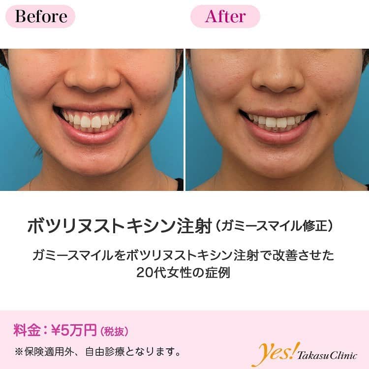 高須クリニックのインスタグラム：「👨🏻‍⚕️高須幹弥医師からのコメント✨⠀ 20代女性の患者様で、ガミースマイルを改善したいというご要望でした。 診察させていただいたところ、笑っていない口を閉じた状態では特別美容的にも問題はないのですが、笑うと歯茎がかなりの面積で見えてしまう状態でした。 歯槽骨の骨格的な問題によるものと考えられました。 患者様は骨切り手術や耳介軟骨移植などによるガミースマイル改善は考えておらず、ボツリヌストキシン注射による治療を希望されていたため、ボツリヌストキシン注射をすることになりました。 上唇挙筋の辺りに左右2箇所ずつボツリヌストキシンを注入しました。 注射後は程よく上唇が上に挙がらなくなり、普通に笑っただけではほとんど歯茎は見えなくなりました。 ---------------------------------------------------- 🌈料金✨⠀ ●ボツリヌストキシン注射（ガミースマイル修正） ¥50,000【東京、横浜、名古屋、大阪】 ---------------------------------------------------- ⚠️リスク・副作用・合併症✨⠀ ●ボツリヌストキシン注射（ガミースマイル修正） 内出血（注射針が血管に当たってしまった場合） 妊活中、妊娠中、授乳中は注射できない --------------------------------------------------- 😊施術についての詳細✨⠀⠀ https://www.takasu.co.jp/photo/gammy_botox003.html ---------------------------------------------------- 📞ご予約・お問い合わせ✨⠀ 0120-5587-10⠀ https://www.takasu.co.jp/cgi-bin/form/contact.cgi ※症例写真や施術に関するご質問なども上記までお願い致します。 ---------------------------------------------------- #ガミースマイル #ガミースマイル修正 #ボツリヌストキシン注射 #ガミースマイルを改善したい #笑うと歯茎が見えてしまう  #皮膚 #美容 #美肌 #エイジングケア #美容整形 #美容外科 #美容クリニック #美容好き #美容皮膚科 #モニター #モニター募集 #高須クリニック #高須クリニック名古屋 #高須幹弥 #整形したい #プチ整形 #症例 #症例写真 #可愛くなりたい #可愛い #美人」