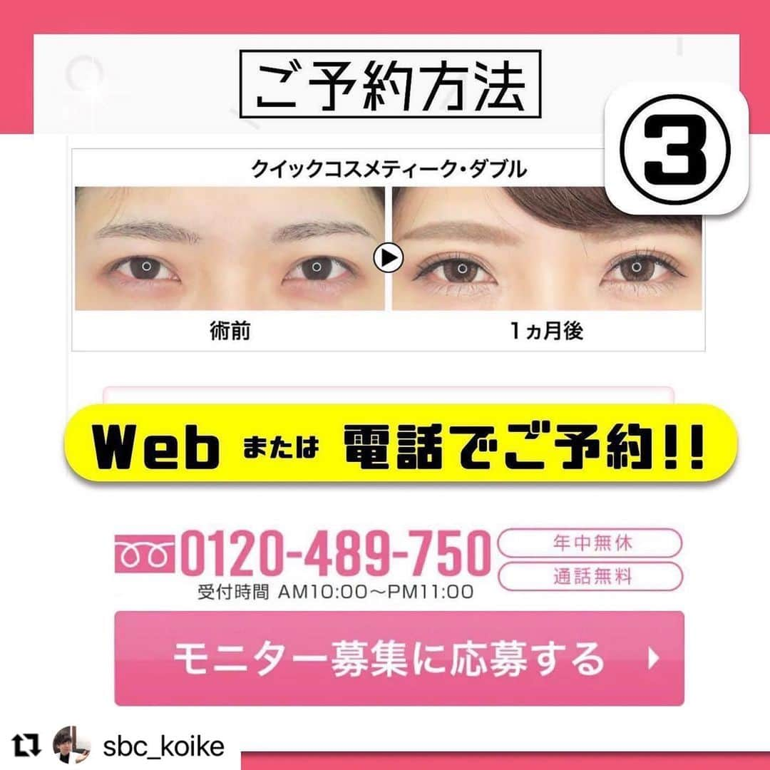 湘南美容外科 柏院さんのインスタグラム写真 - (湘南美容外科 柏院Instagram)「#Repost @sbc_koike with @make_repost ・・・ 切開二重で厚ぼったさを改善！ ■ 【部分モニター】たるみ取り併用全切開 ＋roof切除　259,270円 目頭切開プレミアム　132,240円  厚い脂肪が付いている目元には、全切開＋roof切除を行います。 埋没法が取れてしまう方や、たるみや瞼の厚みをとってスッキリした目元にしたい方に。 roofとは眉毛と目の間にある脂肪のことです。  切開二重はダウンタイム2〜4週間となります。  切開の傷は徐々に目立たなくなりますが半年〜1年ほどかかります  切開二重術は、埋没法二重術に比べ自分のポテンシャル以上の二重にする事も出来ます。  二重が埋没法で思い通りにならなかった方、ぜひご相談下さい。 他院修正も行なっております。 ・ 埋没法でも切開法でも自然なデザインを意識して、『整形感のない自然な二重』をモットーにしています。 ・ 👨‍⚕️美容外科医×🇯🇵心臓血管医×🇰🇷韓国美容整形の技術で、お客様のご要望に応えます ・ ご予約の際は「小池院長のインスタを見た」と伝えて頂けるとスムーズにご案内出来ます📩 . 🏥湘南美容クリニック柏院長 小池泰弘  .※施術を受けたことにより、傷、内出血、腫れ、痛み、感染、左右差、麻酔によるアナフィラキシーが起こるリスクがあります。  #湘南美容クリニック #小池泰弘 #美容外科  #インスタグラマー #二重 #埋没法  #柏  #整形 #目頭切開  #目整形 #二重術セレクション #フォーエバー二重 #クイックコスメティークダブル #小池式クイックコスメティークダブル #全切開 #眼瞼下垂 #埋没法経過 #全切開経過 #二重になりたい #かわいい  #小池式切開二重  #エイジングケア湘南 #たるみ改善湘南 #薄毛治療なら湘南AGA #マウスピース矯正なら湘南歯科 #痩身歴トップ湘南美容 #バストアップなら湘南美容」12月9日 13時54分 - sbc_kashiwa