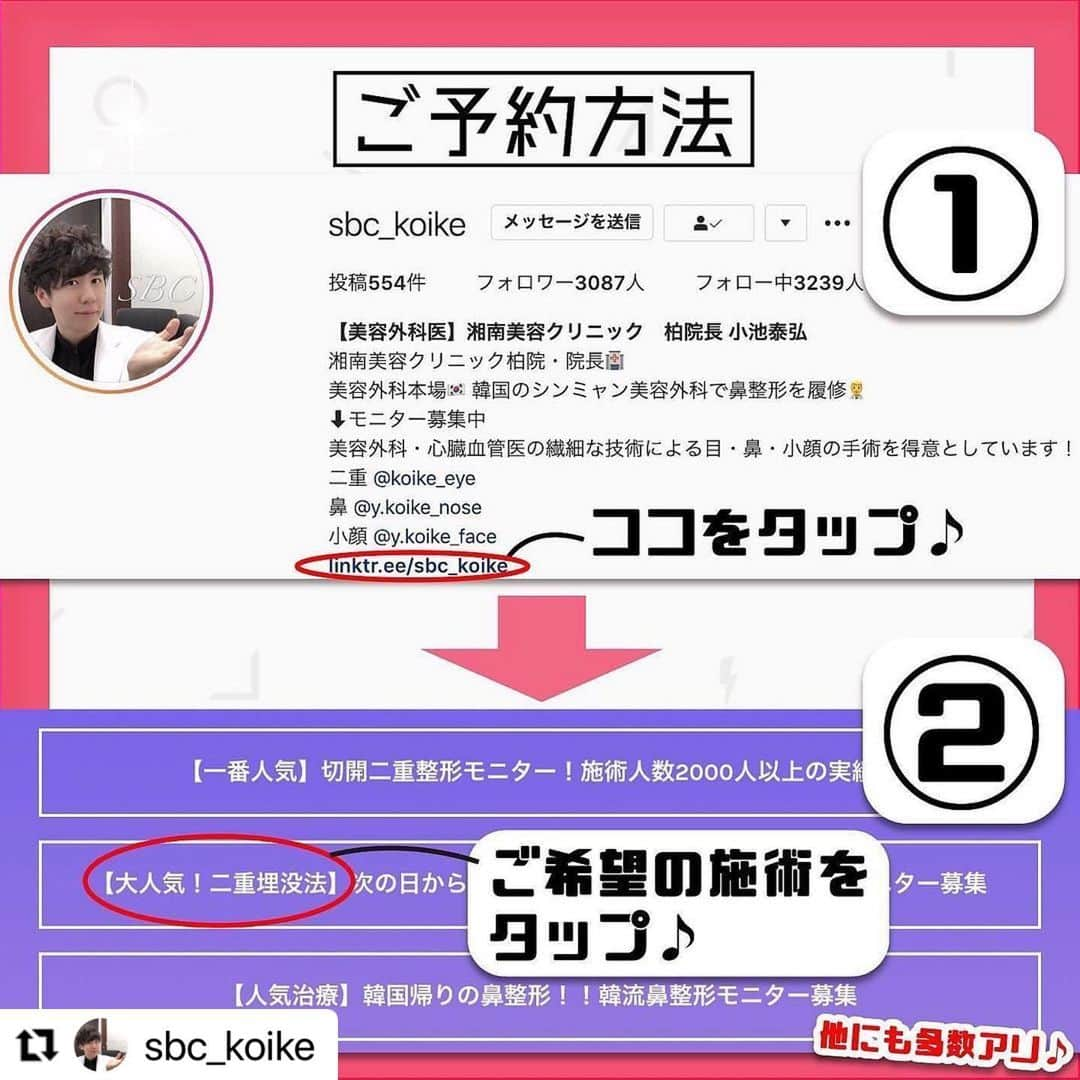 湘南美容外科 柏院さんのインスタグラム写真 - (湘南美容外科 柏院Instagram)「#Repost @sbc_koike with @make_repost ・・・ 切開二重で厚ぼったさを改善！ ■ 【部分モニター】たるみ取り併用全切開 ＋roof切除　259,270円 目頭切開プレミアム　132,240円  厚い脂肪が付いている目元には、全切開＋roof切除を行います。 埋没法が取れてしまう方や、たるみや瞼の厚みをとってスッキリした目元にしたい方に。 roofとは眉毛と目の間にある脂肪のことです。  切開二重はダウンタイム2〜4週間となります。  切開の傷は徐々に目立たなくなりますが半年〜1年ほどかかります  切開二重術は、埋没法二重術に比べ自分のポテンシャル以上の二重にする事も出来ます。  二重が埋没法で思い通りにならなかった方、ぜひご相談下さい。 他院修正も行なっております。 ・ 埋没法でも切開法でも自然なデザインを意識して、『整形感のない自然な二重』をモットーにしています。 ・ 👨‍⚕️美容外科医×🇯🇵心臓血管医×🇰🇷韓国美容整形の技術で、お客様のご要望に応えます ・ ご予約の際は「小池院長のインスタを見た」と伝えて頂けるとスムーズにご案内出来ます📩 . 🏥湘南美容クリニック柏院長 小池泰弘  .※施術を受けたことにより、傷、内出血、腫れ、痛み、感染、左右差、麻酔によるアナフィラキシーが起こるリスクがあります。  #湘南美容クリニック #小池泰弘 #美容外科  #インスタグラマー #二重 #埋没法  #柏  #整形 #目頭切開  #目整形 #二重術セレクション #フォーエバー二重 #クイックコスメティークダブル #小池式クイックコスメティークダブル #全切開 #眼瞼下垂 #埋没法経過 #全切開経過 #二重になりたい #かわいい  #小池式切開二重  #エイジングケア湘南 #たるみ改善湘南 #薄毛治療なら湘南AGA #マウスピース矯正なら湘南歯科 #痩身歴トップ湘南美容 #バストアップなら湘南美容」12月9日 13時54分 - sbc_kashiwa