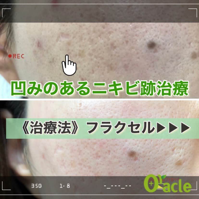 オラクル美容皮膚科東京新宿院さんのインスタグラム写真 - (オラクル美容皮膚科東京新宿院Instagram)「フラクセル治療中の患者様から﻿ 経過写真を送っていただきました🙇‍♀  ニキビ跡が一部クレーター状になり凸凹した状態で、その周りの毛穴の開きも目立つ状態でした。  凹みのあるニキビ跡は表面を滑らかな状態に戻すにはフラクセルでの治療がおすすめです。 また回数は必要となります🙇‍♀️  📷　下　フラクセル4回目から2週間後 ※6回治療予定  🌈毛穴が小さくなり、凸凹も少し目立たなくなっていてさらに肌トーンもUP  凹みのあるニキビ跡は治療が難しく回数も10回程度は必要になりますが、フラクセルなら改善は期待できます🙆‍♀️﻿  ⏰ダウンタイムついて  ダウンタイムもありハードな治療ですが、管理をセットでつけアフターケをしっかり行うことで軽減されます。 当院では韓国式の治療法をご提案しております ﻿ ダウンタイムがあり治療のタイミングも難しいですが、しっかり治したい方にはフラクセルがおすすめです。 ﻿ ➡︎ダウンタイム1週間程度、強い赤みは3〜4日﻿ ➡︎再生管理or鎮静管理とセットで受けられることをおすすめします。 ﻿ ﻿ ⏰ダウンタイム目安﻿ ﻿ 施術直後は赤みだけでなくひりつきや痛みもありますが、その日の内に痛みは大分落ち着きます！﻿ ﻿ 赤みは2.3日続く場合もあるので赤みが出ている場合はあまりお身体を温めすぎないように注意しましょう☝️﻿ ﻿ レーザーで皮膚に小さな穴を開けているので、点々と細かい跡が顔全体に残ります。﻿ ﻿ これが徐々にかさぶたになっていきますが、かなりザラザラする上に顔が黒い点々だらけになるのでマスクは必須🤔﻿ ﻿ その後約1週間かけて皮剥けが終わるとツルッとしたお肌に😍﻿ ﻿ 初めて受ける方はダウンタイムが少し辛く感じるかもしれませんが、終わった後のツルッと感を是非体感して頂きたいです！﻿ ㅤㅤㅤㅤㅤㅤㅤㅤㅤㅤㅤㅤㅤ﻿ 回数を重ねるごとにお肌の毛穴やボコボコが薄くなるのを感じられます🥰﻿  ︎﻿ ୨୧┈┈┈┈┈┈┈┈┈┈┈┈┈┈┈┈┈୨୧ ﻿ ﻿ フラクセルとは❔﻿ ﻿ ※点々と顔に広がる毛穴﻿ ※深く刻まれたクレーター﻿ ※色素沈着したニキビ跡﻿ ※開いて目立つ毛穴﻿ ﻿ などの治療に適したレーザーです👉﻿ ﻿ ニキビ跡、クレーター肌、でこぼこになってしまったお肌をフラクセルで綺麗に🥺✨✨﻿ ﻿ 根気がいる治療ですが、しっかり治療を行えば改善することができます。﻿ ﻿ 【料金】税抜﻿ 部分　　7,200円﻿ 全顔　19,800円﻿ フラクセルには再生管理・鎮静管理とのセット治療がダウンタイム軽減にもおすすめです。﻿ ﻿ ※部分は鼻の毛穴の開きなどが目安で、鼻のみの方も非常に多いです﻿ ﻿ ⚠️リスク﻿ 1週間前後ダウンタイム﻿ ヒリつきやざらつき、ほてりや赤み、腫れ、皮剥けなど﻿ ※効果には個人差があります。﻿ ﻿ ﻿ ▪️▫️▪️▫️▪️▫️▪️▫️▪️▫️﻿ ﻿ #美容 #美活 #美容皮膚科 #皮膚科﻿ #美肌 #美白 #スキンケア #ニキビ跡 #クレーター肌 #フラクセル #フラクショナルレーザー #オラクル美容皮膚科 #毛穴 #毛穴ケア #ニキビ #色素沈着 #ニキビ #ニキビケア﻿ #ニキビ治療 #ニキビ治療専門 #凸凹肌 #フラクショナル #ニキビ専門 #オラクルフラクセル﻿ #オラクルニキビ症例」12月10日 9時44分 - oraclejp