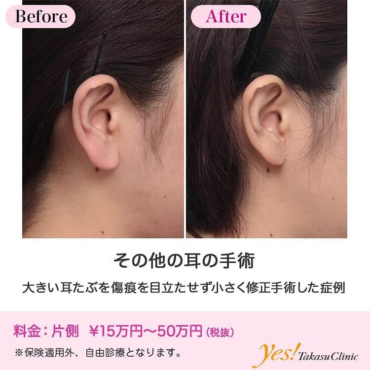 高須クリニックのインスタグラム：「👨🏻‍⚕️高須幹弥医師からのコメント✨⠀ 30代女性の患者様で、両側の耳たぶが大きいのがコンプレックスで来院されました。 診察させていただいたところ、左右の耳たぶの面積が非常に大きく、下にぶら下がっていました。 大きい耳たぶを小さくする耳たぶ縮小手術をすることになりました。 手術は局所麻酔下に余分な耳たぶを楔状に切除し、溶ける吸収糸で中縫いした後、青色透明のナイロン糸で皮膚の表面を縫合しました。 1週間後に皮膚を縫合した糸を抜糸し、4ヶ月後には傷痕はほとんど目立たなくなりました。 耳たぶを小さくする耳たぶ縮小手術は色々な方法がありますが、この術式デザインだと、傷痕が耳の付け根の位置にくるため、傷痕がほとんど目立ちません。 ---------------------------------------------------- 🌈料金✨⠀ ●その他の耳の手術 片側 ¥150,000~500,000【東京、横浜、名古屋、大阪】 ---------------------------------------------------- ⚠️リスク・副作用・合併症✨⠀ ●その他の耳の手術 手術後に処方する抗生剤や痛みどめによるアレルギー症状 仕上がりのわずかな左右差（完璧なシンメトリーは不可） --------------------------------------------------- 😊施術についての詳細✨⠀⠀ https://www.takasu.co.jp/photo/mimiother09.html ---------------------------------------------------- 📞ご予約・お問い合わせ✨⠀ 0120-5587-10⠀ https://www.takasu.co.jp/cgi-bin/form/contact.cgi ※症例写真や施術に関するご質問なども上記までお願い致します。 ---------------------------------------------------- #その他の耳の手術 #耳たぶ縮小手術 #耳たぶを小さくしたい #大きい耳たぶ  #皮膚 #美容 #美肌 #エイジングケア #美容整形 #美容外科 #美容クリニック #美容好き #美容皮膚科 #モニター #モニター募集 #高須クリニック #高須クリニック名古屋 #高須幹弥 #整形したい #プチ整形 #症例 #症例写真 #可愛くなりたい #可愛い #美人」