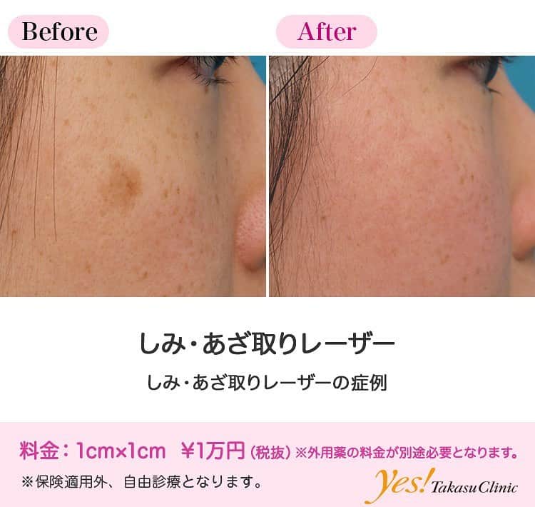 高須クリニックのインスタグラム：「👨🏻‍⚕️高須幹弥医師からのコメント✨⠀ 30代女性の患者様です。 右の頬骨の上にぼんやりとしたシミがありました。 このシミは老人性色素斑というシミで、肝斑などの特殊なシミとは違い、いわゆる普通のシミです。 このタイプのシミには、シミ取り専用のしみ・あざ取りレーザーが効果があります。 レーザー照射後、シミのあったところはすっかりきれいになりました。 レーザーでシミがきれいになった後はケアが大事です。 シミというのは、皮膚の老化現象によってできるものなので、せっかくレーザーできれいになっても、毎日紫外線を浴びていたら、またシミができてしまいます。 特にこのシミのような頬骨の上の出っ張っているところは紫外線が当たりやすいので注意が必要です。 ---------------------------------------------------- 🌈料金✨⠀ ●しみ・あざ取りレーザー 1cm×1cm ¥10,000※外用薬の料金が別途必要となります。【全院】 ---------------------------------------------------- ⚠️リスク・副作用・合併症✨⠀ ●しみ・あざ取りレーザー 肌のほてり・発赤（照射後／肌が弱い方・敏感肌の方） --------------------------------------------------- 😊施術についての詳細✨⠀⠀ https://www.takasu.co.jp/photo/shimi_pic09.html ---------------------------------------------------- 📞ご予約・お問い合わせ✨⠀ 0120-5587-10⠀ https://www.takasu.co.jp/cgi-bin/form/contact.cgi ※症例写真や施術に関するご質問なども上記までお願い致します。 ---------------------------------------------------- #しみ #しみ取り #老人性色素斑 #しみ取りレーザー  #皮膚 #美容 #美肌 #エイジングケア #美容整形 #美容外科 #美容クリニック #美容好き #美容皮膚科 #モニター #モニター募集 #高須クリニック #高須クリニック名古屋 #高須幹弥 #整形したい #プチ整形 #症例 #症例写真 #可愛くなりたい #可愛い #美人」