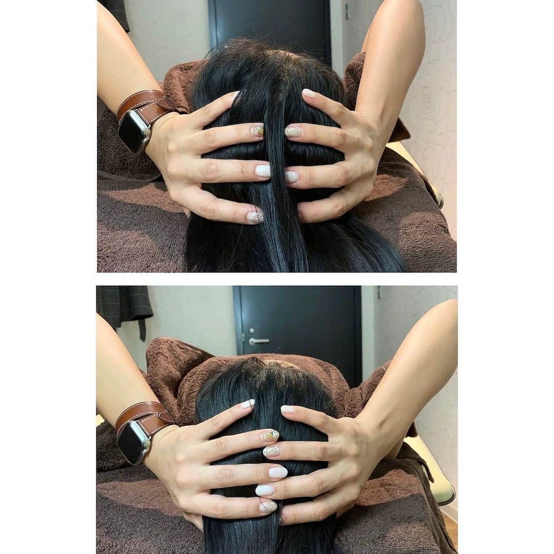 小城綾佳のインスタグラム：「🌿お客様Before After🌿 . 脳脊髄液を循環させ 脳の老廃物を流すことで 脳疲労を取り全身を活性化します . 目に見てわかる 小頭や小顔はもちろんのこと 肩凝り.首凝り.頭痛.眼精疲労.歪み にも効果があります🌿 . 健康のためには内側から 根本から改善する必要があります 身体の不調を覚えたら ご連絡下さい🌿 . 脳洗浄以外にも 矯正施術で改善されたり 知識や習慣で改善されることもあります🌿 お気軽にご相談ください . #脳洗浄#小顔矯正#骨盤矯正#猫背矯正#矯正サロン#パラフューズ#脳洗浄大阪」