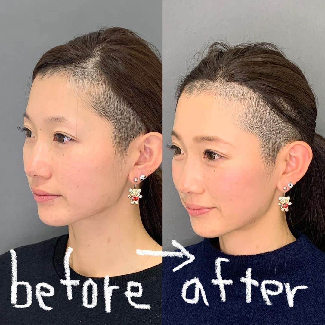中里さや香のインスタグラム：「3回目の東京中央美容外科高田馬場院さん　@tcb_takadanobaba に行ってきました😊  ・ 1ヶ月程通ったのですが、左before→右afterの写真、フェイスラインの部分が上に引き締まってるの分かりますか？🥺ほっぺの筋肉も上に上がってる！  ・ 顔が引き締まるだけで、化粧のノリも良くなったし、肌の色もワントーン上がった気がします✨✨  ・ ハイフのソノクイーンは東京中央美容外科さんでしか受けられないので肌を引き締めたい方・肌を活性化したい方に本当オススメですー😆👍  ・ 高田馬場院さんはスタッフの方も、土門院長先生　@tcb_domon も優しいのでまずはご相談してみてくださいー✨  ・ #リフトアップならtcb東京中央美容外科 #美容整形ならtcb東京中央美容外科 #東京中央美容外科 #美容外科#高田馬場#東京中央美容外科高田馬場院#土門駿也 #ソノクイーン#ハイフ#hifu#リフトアップ#PR#中里さや香」