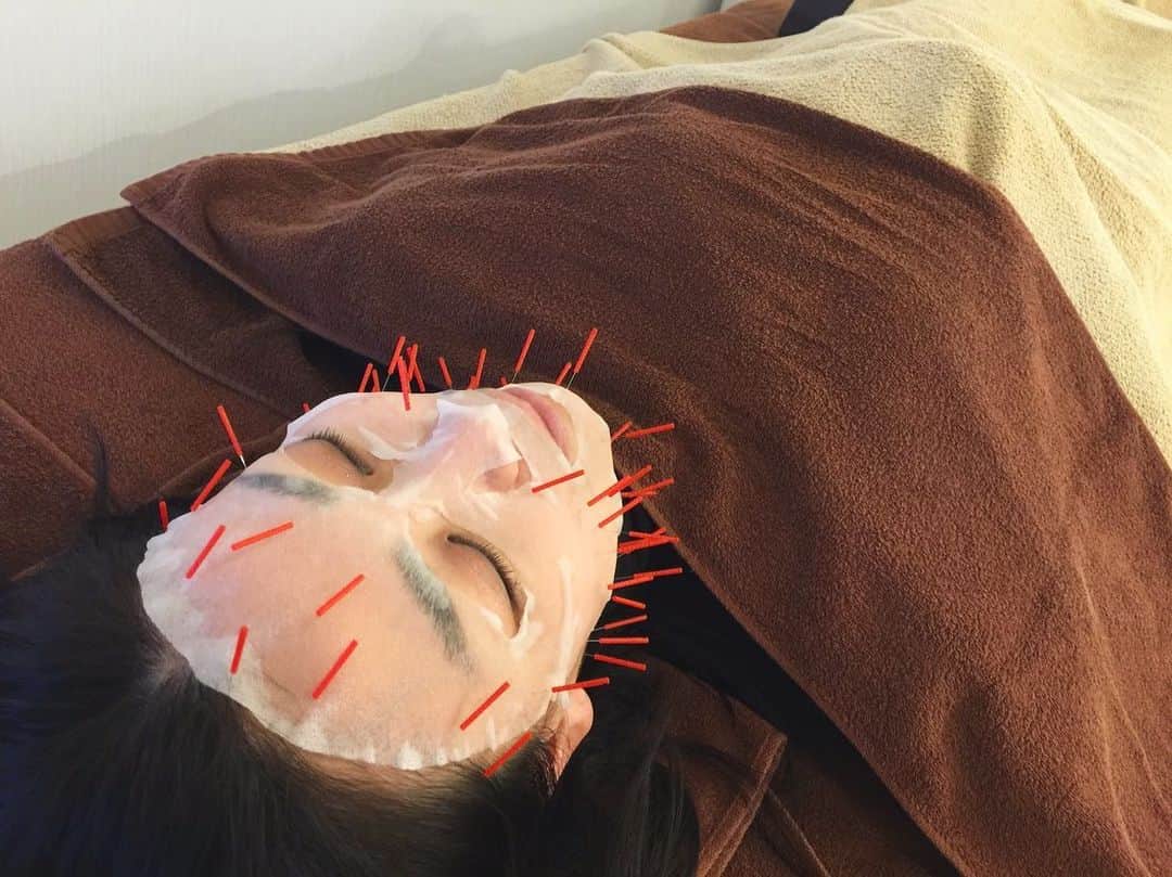 宮崎京さんのインスタグラム写真 - (宮崎京Instagram)「石井整体院 @ishii_yukio にて、 【幹細胞美容鍼®️】を体験👩🏻💡  再生医療で注目の幹細胞培養液がたっぷり染み込んだシートマスク（お写真3枚目）の上から、 鍼を刺していく世界初の美容技術🪄  通常の美容技術では皮膚表面の表皮層までしか届きませんが、 美容液を鍼にからませることにより、 皮膚深部の真皮層まで幹細胞培養液を浸透させていきます💨  特殊なシートマスクの開発と、 独自の熟練の鍼灸技術により実現した、 日本でも数カ所でしか受けられない最新の美容鍼とのこと✨  私は小顔矯正と合わせて美容鍼も、自分へのご褒美美容としてお願いしています💆🏻‍♀️💕  施術後すぐに、顔がスッキリ引き締まってハリが出たなぁ…と実感🥰  2枚目のお写真、顔がピッカピカ。笑  #広尾 #美容鍼 #鍼灸 #整体 #世界初 #幹細胞美容鍼®️  #再生美容 #東洋医学との融合  #肩こり #小顔 #美容 #広尾散歩通り#広尾商店街 #恵比寿 #白金 #南麻布 #石井治療院 #石井治療院広尾サロン」12月15日 15時27分 - miyakomiyazaki
