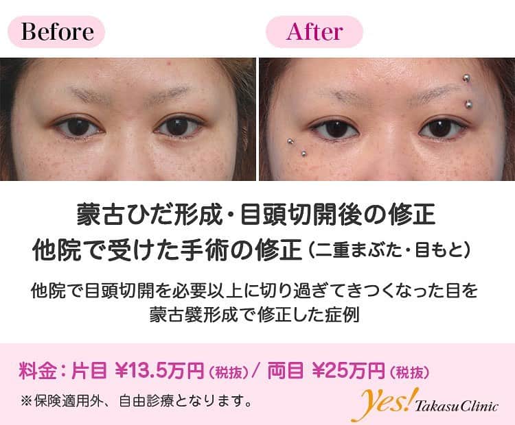 高須クリニックのインスタグラム：「👨🏻‍⚕️高須幹弥医師からのコメント✨⠀ 20代女性の患者様で、他院で目頭切開をしたのですが、希望よりも大きく切られてしまったため、寄り目になってしまい、きつい印象になってしまいました。 どのような術式で手術されたのかは不明でしたが、皮膚を切除されたようでした。 皮膚を切除されている場合は、完全に元に戻すことは難しいですが、ある程度は戻すことはできます。 患者様の希望は、完全に元に戻すのではなく、元の状態と今の状態の中間くらいにしたいとのことだったので、逆Z法で蒙古襞形成をすることになりました。 小さい蒙古襞を作ったことにより、約2mmずつ目頭を戻しました。 その結果、術前に丸見えだった涙丘（目頭の赤い粘膜の盛り上がった部分）が少し隠れ、目と目の間隔が広がり、きつい印象が改善しました。 ---------------------------------------------------- 🌈料金✨⠀ ●蒙古ひだ形成・目頭切開後の修正 片目 ¥135,000 / 両目 ¥250,000【東京、横浜、名古屋、大阪】 ---------------------------------------------------- ⚠️リスク・副作用・合併症✨⠀ ●蒙古ひだ（蒙古襞）形成・目頭切開後の修正 内出血（術後） 仕上がりのわずかな左右差（完璧なシンメトリーは不可） 仕上がりが完璧に自分の理想の形にならないことがある --------------------------------------------------- 😊施術についての詳細✨⠀⠀ https://www.takasu.co.jp/photo/hida05.html ---------------------------------------------------- 📞ご予約・お問い合わせ✨⠀ 0120-5587-10⠀ https://www.takasu.co.jp/cgi-bin/form/contact.cgi ※症例写真や施術に関するご質問なども上記までお願い致します。 ---------------------------------------------------- #蒙古ひだ形成 #目頭切開後の修正 #他院で受けた手術の修正 #目頭切開 #寄り目改善 #蒙古襞形成  #皮膚 #美容 #美肌 #エイジングケア #美容整形 #美容外科 #美容クリニック #美容好き #美容皮膚科 #モニター #モニター募集 #高須クリニック #高須クリニック名古屋 #高須幹弥 #整形したい #プチ整形 #症例 #症例写真 #可愛くなりたい #可愛い #美人」