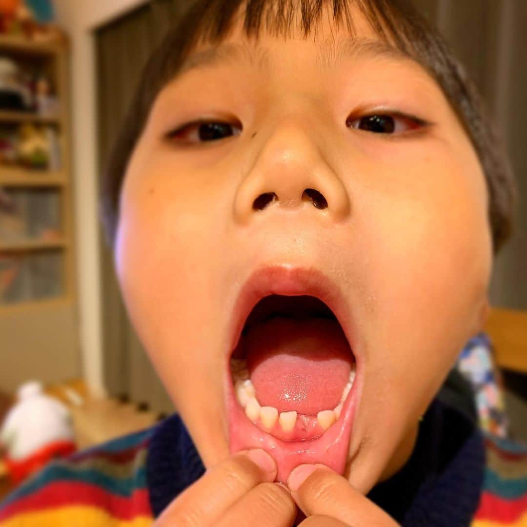 藪木健太郎さんのインスタグラム写真 - (藪木健太郎Instagram)「初めて歯が抜けた🦷」1月9日 19時41分 - kentaroyabuki