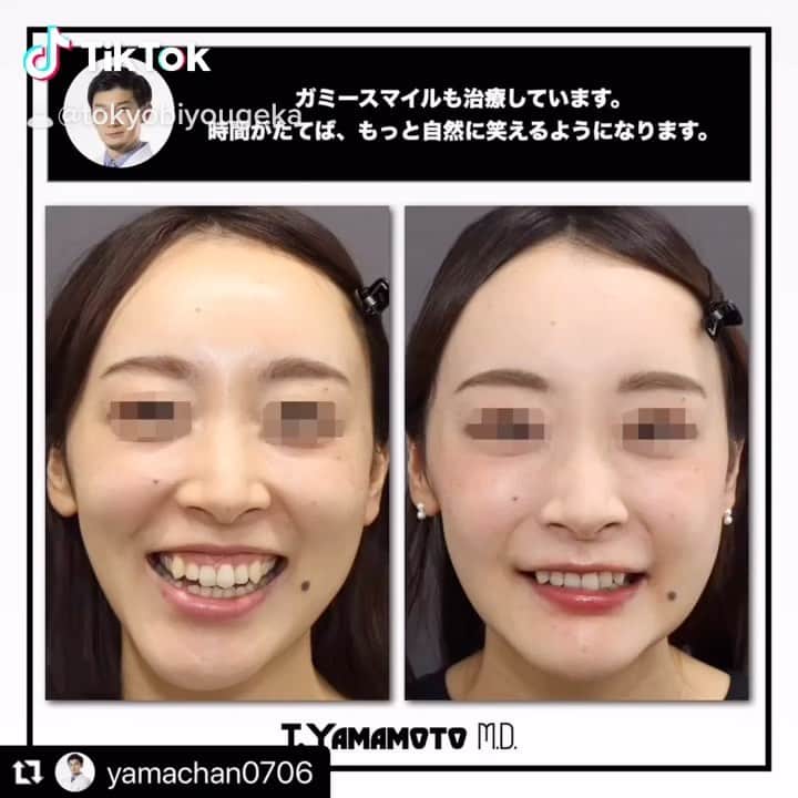 東京美容外科公式のインスタグラム：「東京先進医療クリニック（東京美容外科）赤坂院では骨切り手術と豊胸、歯科の無痛治療を専門としております。それぞれの専門医と常勤の麻酔科医が在籍し高度な技術をご提供致します👨‍⚕  . . . 📞お問い合わせはこちら💁🏼‍♀️ 詳しくはプロフィールのURLから公式サイトへ. ▼フリーダイヤル 0120-658-958 （コールセンター受付時間：9：00～21：00） ▼LINE予約 @ tkc110 ========================= #東京美容外科#美容整形#整形#美活#美容#美容外科#特別外来#他院修正#鼻#豊胸#鼻中隔延長#オープン法#エイジング#美白#美肌#鼻#韓国#名古屋#オンライン#輪郭形成#院長#」