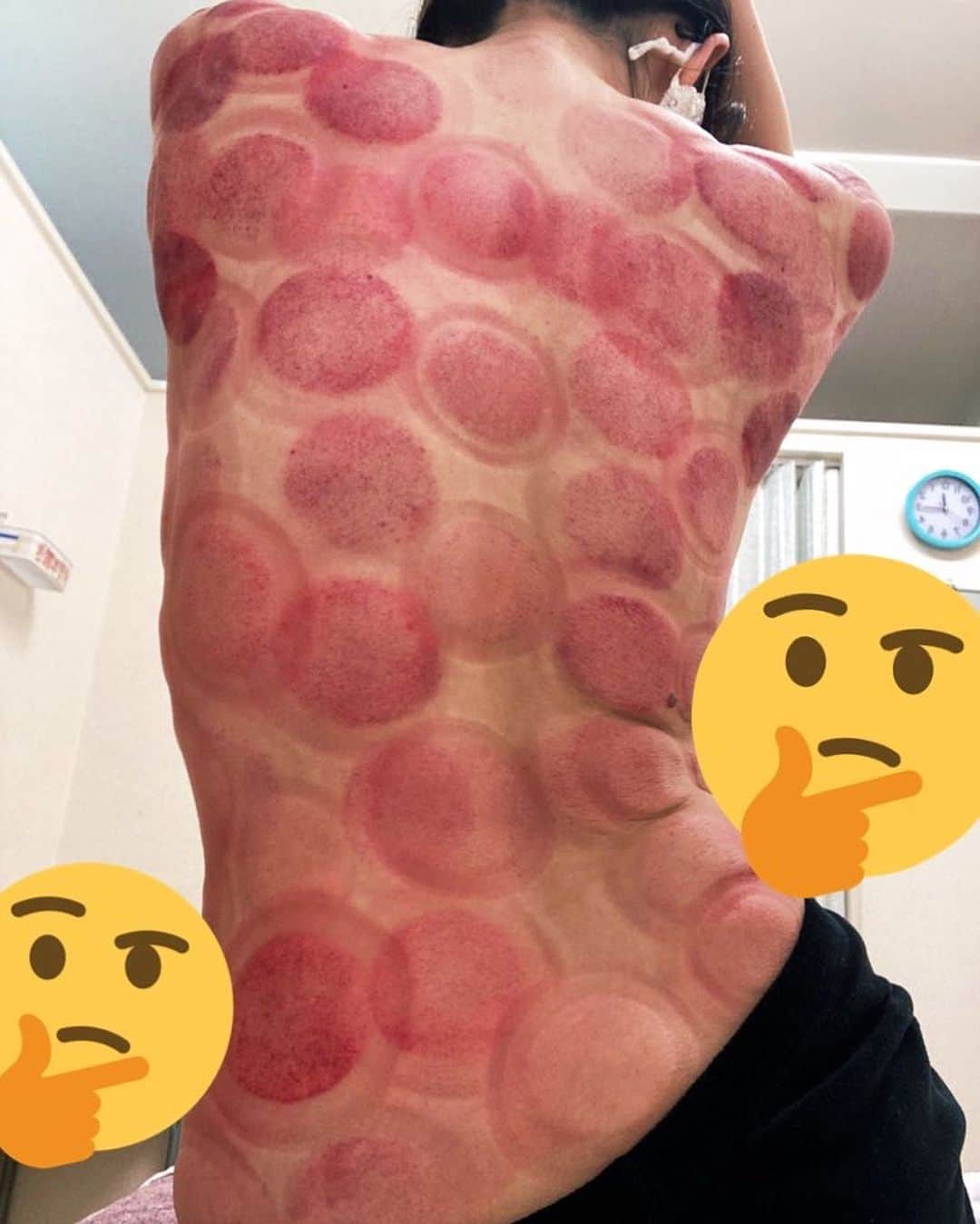 小明のインスタグラム：「背中と腰が限界値を超えた……！と思って急遽カッピングへ！いつも痛いのは背中と腰なのにマッサージ師さんには「あなたがまずいのは肩」も言われて、確かに色味は肩が一番強くてベジータみたい、強そう〜。おかげで背中が軽くなったけどしばらくはアザとして痛いぞ。」