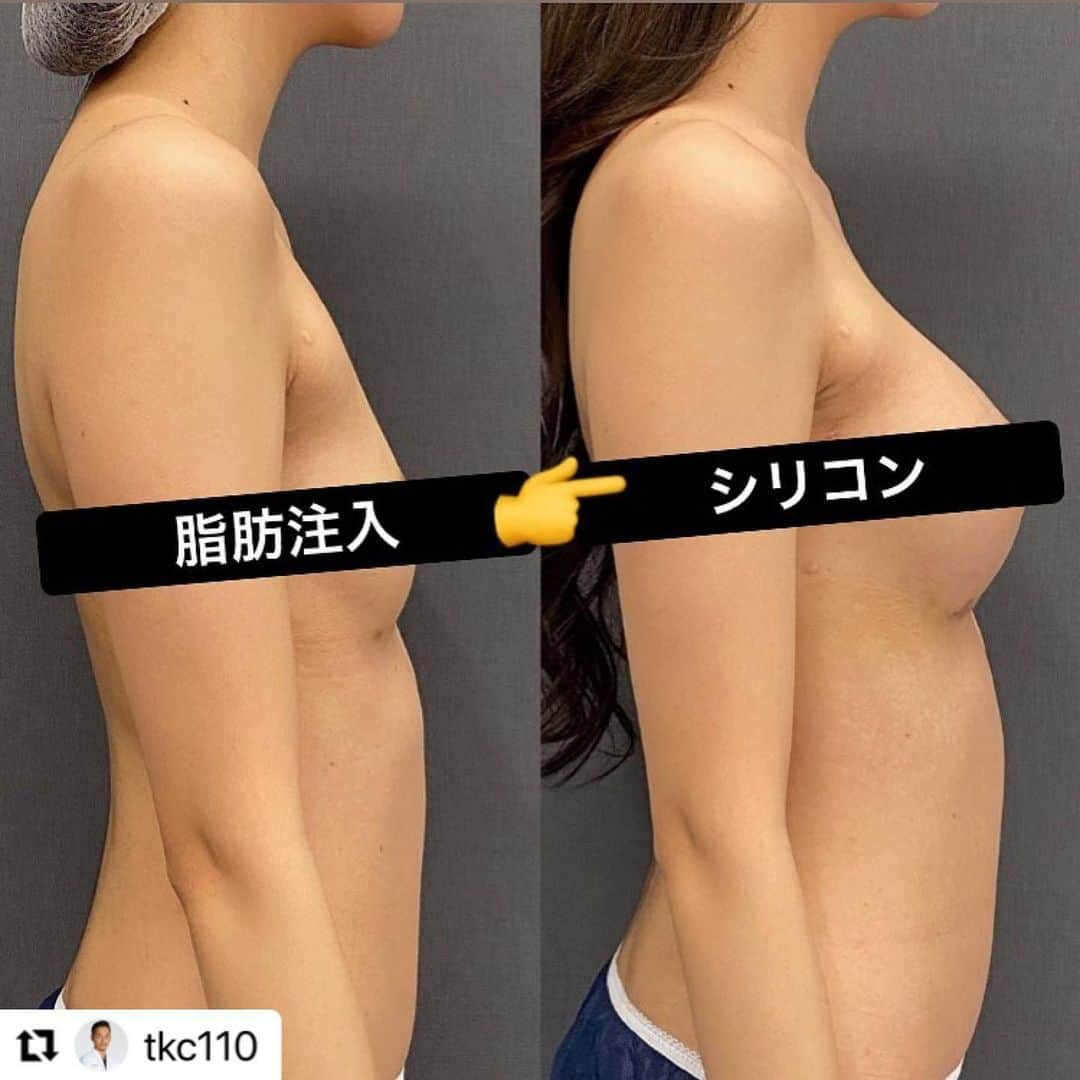 東京美容外科公式さんのインスタグラム写真 - (東京美容外科公式Instagram)「新宿院院長小野先生の症例のご紹介です。 脂肪注入豊胸→シリコン豊胸 #Repost @tkc110 with @make_repost ・・・ 脂肪注入豊胸やヒアルロン酸豊胸をした患者さんが、やっぱりシリコンによる豊胸したいと来院されることが多いです。 この方は他院で脂肪注入豊胸後に感染をおこしてしまい、その修正でした。 詳細は個人アカウント @doctorjumpeiono に投稿があります。 今週来週も毎日豊胸手術してます💦 #小野准平 #豊胸 #シリコン豊胸 #脂肪注入豊胸 #ヒアルロン酸豊胸 #デュアルプレーン豊胸 #ハイブリッド豊胸 #コンデンスリッチ豊胸 #バストアップ #育乳 #ナイトブラ #ビキニ #ボディメイク #くびれ作り #ダイエット #トレーニング #新宿 #歌舞伎町 #キャバクラ #キャバ嬢 #ホステス #モデル #ギャル #ダンサー #整形垢」1月11日 10時10分 - tokyobiyougeka_jimukyoku