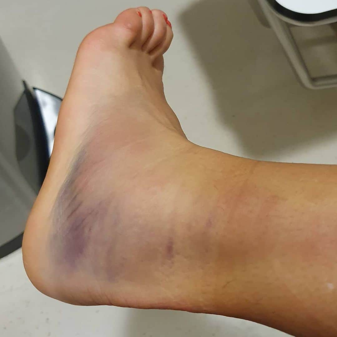 キルステン・フリプケンスさんのインスタグラム写真 - (キルステン・フリプケンスInstagram)「Hi everyone,  I just want to give you all a final update about my injury. I did an MRI and X-ray yesterday. Besides a few strains, some oedema etc I have a partial (grade 2) tear on my ATFL ligament.  I already started rehab with physio here in Abu Dhabi doing treatments, very light range of motions, and aquajogging..  Not the start of the year I had in mind after a great pre season, but I am going to do everything that is in my power to recover as quickly and healthy as possible 🙏   And yes, the goal is Australian Open 🦘 Thanks for all your msgs and i'll keep you posted 💪  Oh btw, take a look at the advertising board.. "Healthpoint" 🙄 (the hospital I went to afterwards 🙈😅) How ironic....」1月12日 2時52分 - kirstenflipkens