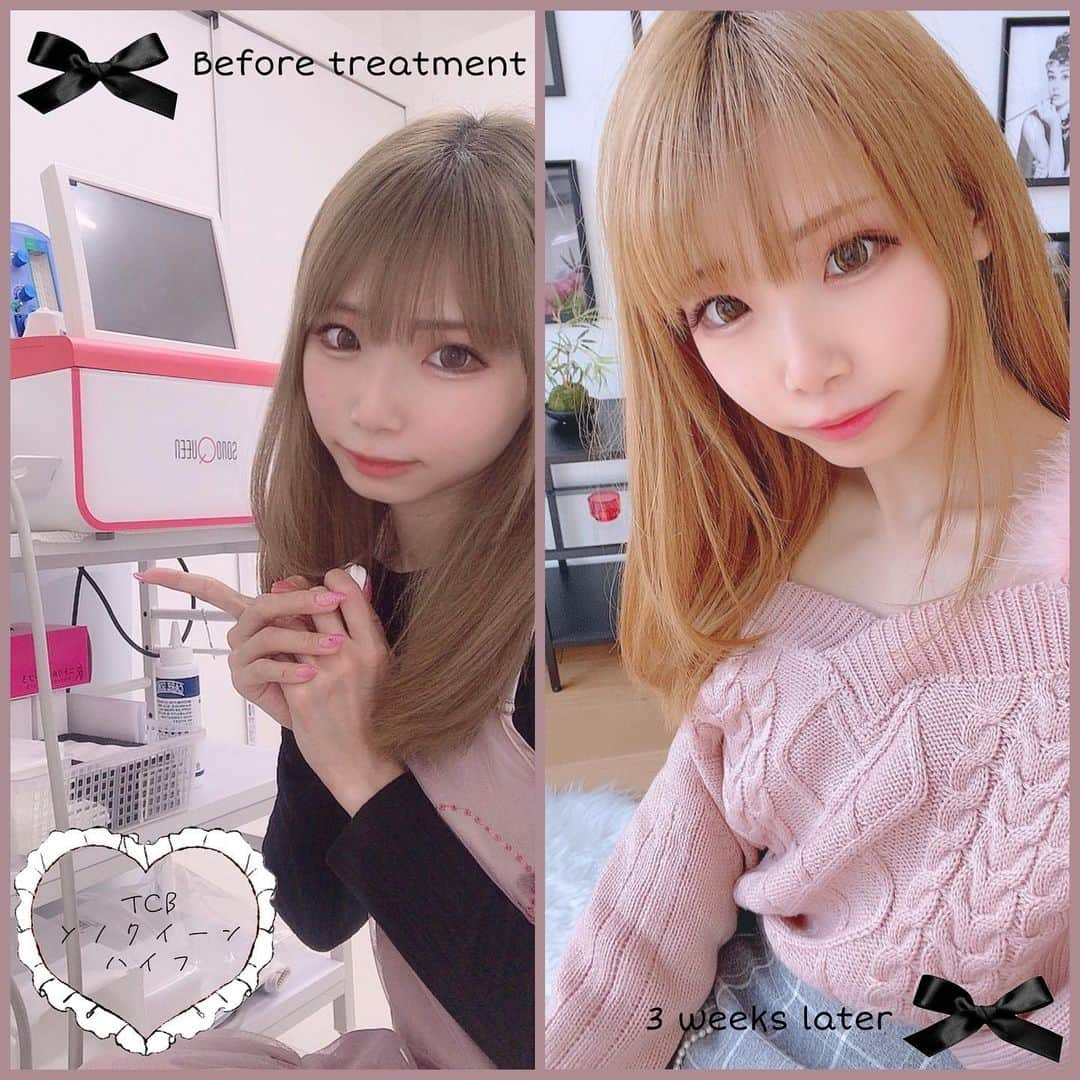 姫宮まほれさんのインスタグラム写真 - (姫宮まほれInstagram)「💎 ソノクイーン　ハイフ経過観察  3週間経ったので経過写真をアップします✨  リフトアップの施術が1番気になっていたので  #東京中央美容外科大宮院（@tcb_omiya） でソノクイーン　 というハイフの施術をしたよ🐰  フェイスラインとほうれい線が気になってたので やって良かった！ 施術後にはリフトアップ感じた🥲✨  私は樅山先生（@tcb_momiyama）にお世話になりました🎀  #リフトアップならtcb東京中央美容外科  #美容整形ならtcb東京中央美容外科  #東京中央美容外科 #美容外科 #大宮 #樅山真紀  #ソノクイーン #ハイフ #HIFU #リフトアップ  #PR   #コスプレイヤー　#撮影会モデル #フェイスライン #小顔」1月12日 14時21分 - mahore07