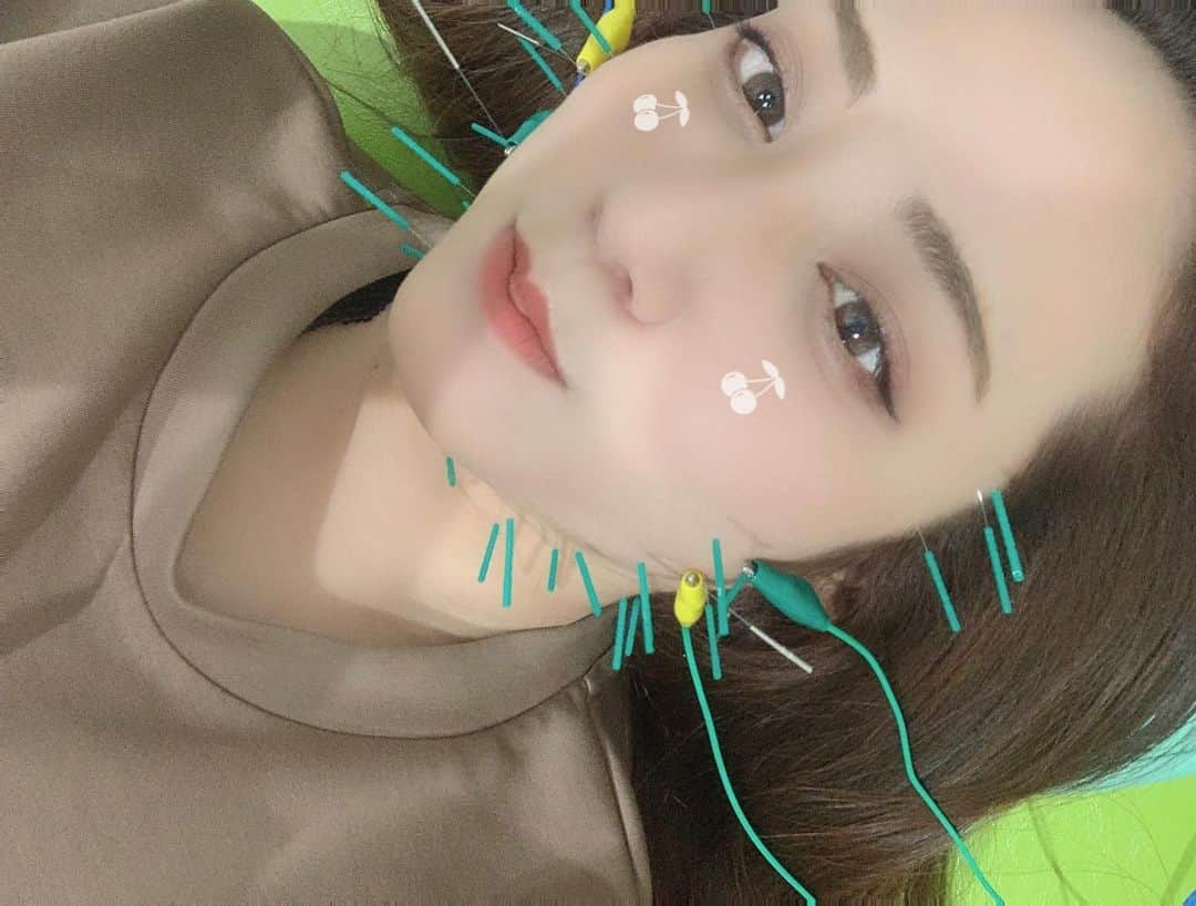 吉村遙さんのインスタグラム写真 - (吉村遙Instagram)「人生で初めての美容鍼🤯 最近身体の痛みで通い始めた整骨院に、昔から気になっていた美容鍼の先生もいらっしゃいまして。これも何かの縁だとやってみました‼️  👩🏻‍🦰刺す時言ってくださいね！怖いから！（心臓バクバク） 👨‍⚕️もう刺さってますよ〜笑  なんともまぁ拍子抜けするぐらい痛くない。痛くなさすぎてこれ効果あるんですか？なんて聞いてしまいました🙄  美容鍼の効果としては、 リフトアップ、肌のくすみ、目の疲れ、肌荒れ、むくみ、毛穴、美白、小顔、化粧ノリ、などなど数え切れないほどの効果があるそうで、、、要は鍼の刺激によって血行が良くなり肌のターンオーバーを早めるそうです◎ なにそれ最高やんか👏👏👏  というわけで、たったの１回でバッチリ効果感じたので続けてみようと思います💆‍♀️💕男女問わずどなたでも出来るそうです！見た目も面白いので皆様も是非〜🤝  🌼美容鍼メニュー🌼 初回4500円（通常6000円） 月4回コース15000円（1回あたり3750円）  @morinoki_sinkyu_seikotsuin  【もりの木整骨院&整体院】 福岡市中央区警固1-1-24KEGO124テラス4-A  #もりの木整骨院#福岡市中央区#美容鍼」1月12日 18時21分 - harupi1019