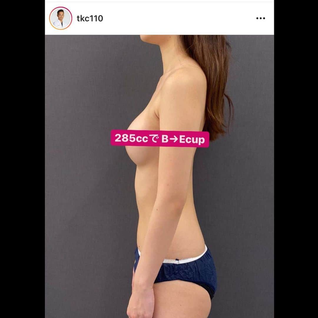 東京美容外科公式さんのインスタグラム写真 - (東京美容外科公式Instagram)「こんにちは‼︎⭐️東京美容外科でございます。 こちらは　新宿院長　小野先生の豊胸後のお写真です😊画面tapで小野先生インスタへ飛べます⭐️👙沢山の症例写真と共に分かりやすい解説つきです。ぜひご覧頂きフォローお願い致します✨🎄 今月も沢山の皆様にご来院頂き誠にありがとうございます✨🎄 年末までまだご案内できる日もございます✨皆様のご来院をこころよりお待ちしております✨ #東京美容外科 #小野准平 #東京美容外科 #新宿 #歌舞伎町 #キャバクラ #キャバ嬢 #クラブ #ホステス #モデル #ギャル #ダンサー #ボディメイク #ベストボディ #トレーニング #くびれ作り #ケツトレ #水着 #ビキニ #ドレス#72時間#麻酔#ダウンタイム軽減」12月21日 10時02分 - tokyobiyougeka_jimukyoku