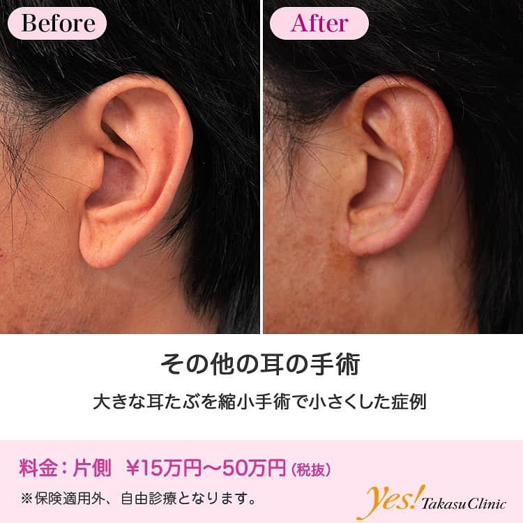 高須クリニックのインスタグラム：「👨🏻‍⚕️高須幹弥医師からのコメント✨⠀ 40代男性の患者様で、大きくて垂れ下がっている耳たぶがコンプレックスで、耳たぶ縮小手術を希望されていました。 診察させていただいたところ、両側の耳たぶは男性の平均サイズより大きめで、垂れ下がっており、俗に言う「福耳」でした。 患者様は、兎に角この耳たぶがコンプレックスで嫌だとのことで、耳たぶを小さくして、垂れ下がっているのも改善したいとのことだったので、患者様のご希望通り、両側の耳たぶ縮小手術をさせていただくことになりました。 手術は局所麻酔下に、両側の耳たぶの皮膚と皮下組織、脂肪を切除し、垂れ下がっている感じがなくなるように、耳たぶの端を付け根の部分に縫合しました。 手術後は、患者様の希望通りの小さくて垂れ下がっていない耳たぶになりました。 人の身体的コンプレックスは千差万別であり、福耳がだらしない、締まりがない印象でコンプレックスだとおっしゃる患者様も少なくはありません。 患者様が希望し、それがその人にとってマイナスにならず、精神的なことも含めてプラスになるのであれば、希望通り手術させていただくことはあります。 ---------------------------------------------------- 🌈料金✨⠀ ●その他の耳の手術 片側 ¥150,000~500,000【東京、横浜、名古屋、大阪】 ---------------------------------------------------- ⚠️リスク・副作用・合併症✨⠀ ●その他の耳の手術 手術後に処方する抗生剤や痛みどめによるアレルギー症状 仕上がりのわずかな左右差（完璧なシンメトリーは不可） --------------------------------------------------- 😊施術についての詳細✨⠀⠀ https://www.takasu.co.jp/photo/other009.html ---------------------------------------------------- 📞ご予約・お問い合わせ✨⠀ 0120-5587-10⠀ https://www.takasu.co.jp/cgi-bin/form/contact.cgi ※症例写真や施術に関するご質問なども上記までお願い致します。 ---------------------------------------------------- #その他の耳の手術 #耳の手術 #耳たぶ縮小手術 #福耳 #耳たぶを小さくしたい #垂れ下がっている耳たぶを改善したい  #皮膚 #美容 #美肌 #エイジングケア #美容整形 #美容外科 #美容クリニック #美容好き #美容皮膚科 #モニター #モニター募集 #高須クリニック #高須クリニック名古屋 #高須幹弥 #整形したい #プチ整形 #症例 #症例写真 #可愛くなりたい #可愛い #美人」
