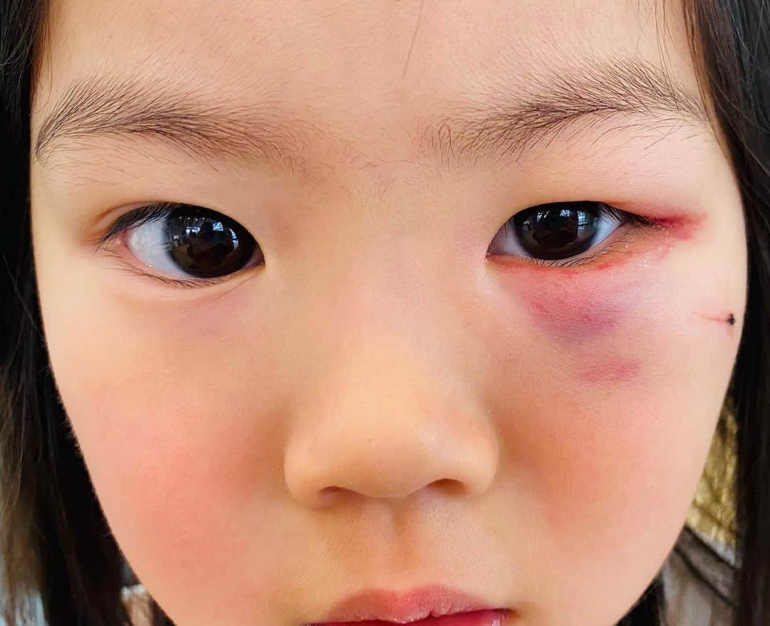 太陽チャンネルのインスタグラム：「らんたまぶー左目負傷😭 撮影後、ハイテンションで走り回ってて ラグにひっかかって派手派手にすっ転んで テーブルにガン！！😭 日に日に内出血が広がって、目が開かなくなる😭 本人あまり気にしてないのかなー？って思ってたんだけど、園でふと鏡を見た時に｢らんちゃんこれ治らないのかな～😿｣って落ち込んでたらしい🥺大丈夫だよ病院の先生も良くなるって言ってたからね😿がんばろうね😿そして気をつけながら生きていこ💪( ◜௰◝ 💪)ご心配おかけしてすみません～😿 あたたかいお言葉ありがとうございます🙇‍♀️💕 #4歳 #ケガ」