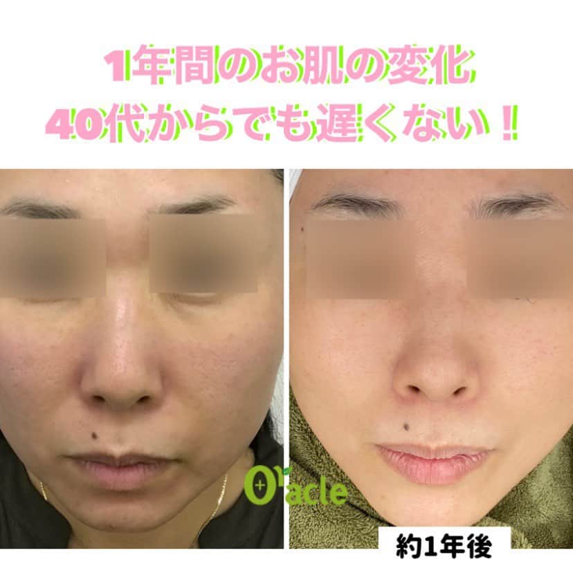 オラクル美容皮膚科東京新宿院さんのインスタグラム写真 - (オラクル美容皮膚科東京新宿院Instagram)「《1年のお肌の比較》﻿ 40代後半から始めた毎月の肌管理から1年以上たち、お肌が本当に変わりました✨ ﻿ 年齢を重ねると特に乾燥が強くなってきます。 乾燥はたるみやシミの原因に😭  ホルモンバランスが乱れてくると色素沈着のリスクも高くなりますので、強いレーザーは頻繁にはできませんが、ピーリングや保湿効果の高い施術を中心に1年間定期的にケア。  さらに自宅でのケアも意識した結果、トラブルの出にくい肌質に改善されました👏  【主な施術】 🌈メソナJ  ☑️トータルアンチエイジングコース　30,000円 ☑️リジュラン幹細胞 58,000円 ﻿⚠️施術中電気のピリピリ感を感じます  🌈マスクミルクピーリング　12,000円 ⚠️施術中ピーリング剤でピリピリ感を感じます  🌈ルメッカ　30,000円 ⚠️施術後赤みが出る場合があります。  肌管理を始めるのに年齢は関係ないです😊 その年代、お肌の状態にあったケアをしてあげることでお肌は変わります🌈 そして続けることが大事☝️﻿ ﻿﻿  ぜひ参考にしてみてください ﻿ ﻿  #美肌 #美肌ケア #美肌作り 　#美白効果 #トーンアップ  #美容皮膚科 #美容 #美容好き #美容部 #美容好きな人と繋がりたい #美容好き #韓国美容 #韓国 #美容オタク　　#미백﻿ #ピーリング　#毛穴﻿ #アンチエイジン#肌管理　#アラフォー美容 #アラフィフ #アラフォー  #アラフォー #オラクル振り返り」12月23日 9時56分 - oraclejp