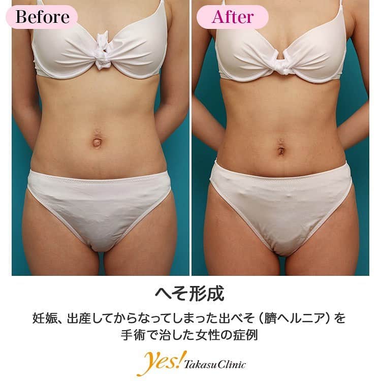 高須クリニックのインスタグラム：「👨🏻‍⚕️高須幹弥医師からのコメント✨⠀ 20代女性の患者様で、出べそを治したいというご要望で来院されました。 患者様曰く、元々出べそではなく、普通の窪んだへそだったのですが、妊娠、出産の後、出べそになっていたとのことでした。 診察させていただいたところ、へその膨らんでいるところを指で押すと凹みました。 また、へその奥のほうを触ると、小さな穴があり、臍ヘルニアであることがわかりました。 手術は、臍ヘルニア根治手術に準じて行い、局所麻酔下に、へその膨らんでいる部分の皮膚を観音扉状に切開して、ヘルニア門を探しだし、ヘルニア門を縫合閉鎖しました。 ソフラチュール（抗生剤軟骨のついた網目状のガーゼ）を丸めてへその窪みに嵌め込み、1週間ガーゼとテープで固定しました。 手術後は出べそは治って、綺麗に窪んだへそになりました。 元々正常なへそだったのに、妊娠、出産をきっかけに臍ヘルニアになってしまうことはよくあります。 その場合、放置していても自然に治ることはありませんが、根治手術をすれば治すことができます。 ---------------------------------------------------- 🌈料金✨⠀ ●へそ形成 単純に出ベソを切除縫縮する場合 ¥150,000 / ヘソヘルニアや複雑な手術になる場合 ¥200,000~300,000【東京、横浜、名古屋、大阪】 ---------------------------------------------------- ⚠️リスク・副作用・合併症✨⠀ ●へそ形成 手術後に処方する抗生剤や痛みどめによるアレルギー症状 仕上がりのわずかな左右差（完璧なシンメトリーは不可） 仕上がりが完璧に自分の理想の形にならないことがある 傷跡が肥厚性瘢痕やケロイドになる可能性 --------------------------------------------------- 😊施術についての詳細✨⠀⠀ https://www.takasu.co.jp/photo/navel011.html ---------------------------------------------------- 📞ご予約・お問い合わせ✨⠀ 0120-5587-10⠀ https://www.takasu.co.jp/cgi-bin/form/contact.cgi ※症例写真や施術に関するご質問なども上記までお願い致します。 ---------------------------------------------------- #へそ形成 #出べそ #臍ヘルニア #出べそを治したい #綺麗に窪んだへそ  #皮膚 #美容 #美肌 #エイジングケア #美容整形 #美容外科 #美容クリニック #美容好き #美容皮膚科 #モニター #モニター募集 #高須クリニック #高須クリニック名古屋 #高須幹弥 #整形したい #プチ整形 #症例 #症例写真 #可愛くなりたい #可愛い #美人」