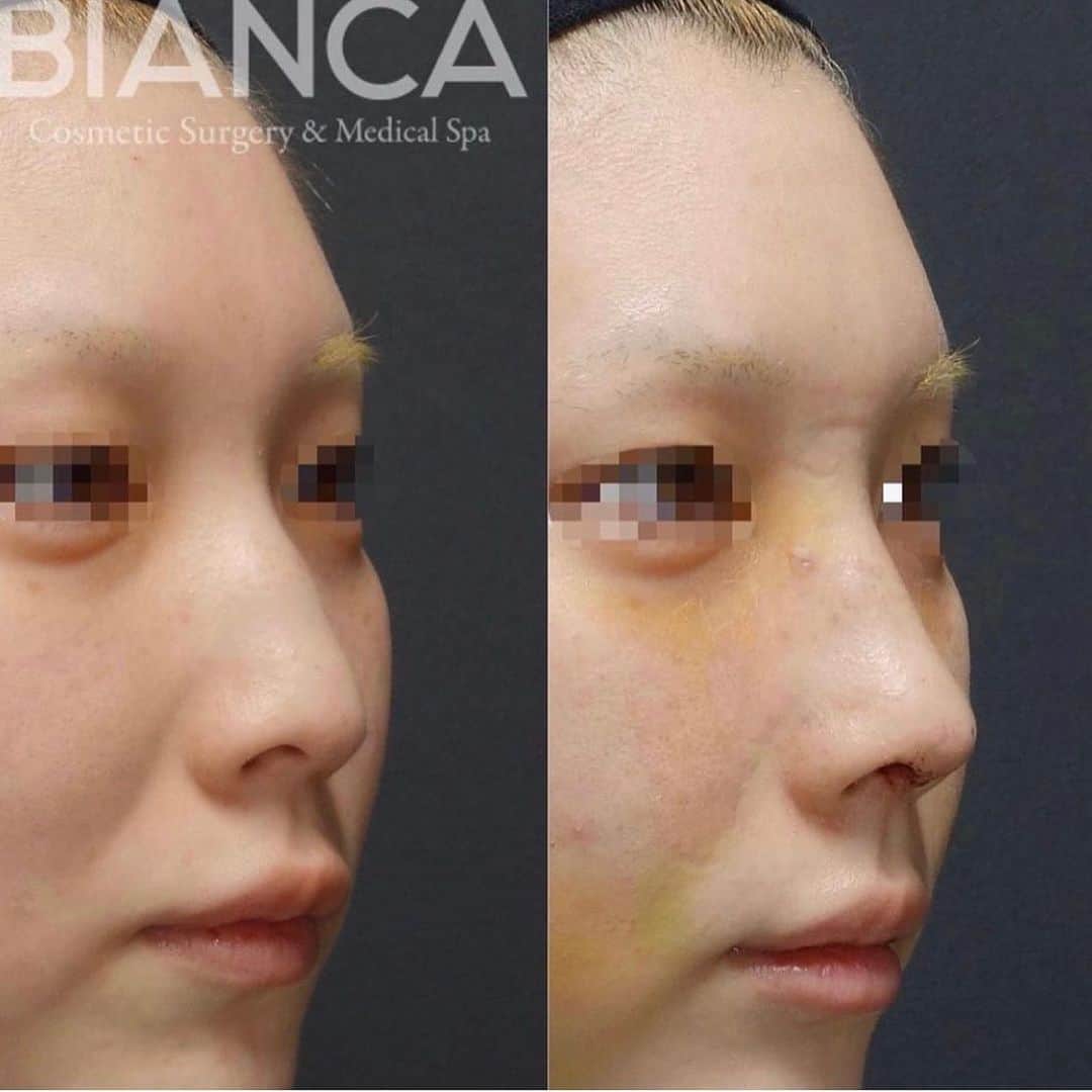 辻沢由有（BIANCA CLNIC 表参道院 院長）さんのインスタグラム写真 - (辻沢由有（BIANCA CLNIC 表参道院 院長）Instagram)「👃🏻BIANCA RHINOPLASTY👃🏻 形成外科専門医チームによる鼻整形❗️ プロテーゼや鼻中隔延長はもちろん、 肋軟骨や筋膜などを使い自家組織でも美しいお鼻にすることが可能です✨  BIANCAでは、美しさはもちろん、機能面も重要と考えております。 aestheticそしてfunctional、両面のバランス取れた最高のお鼻を目指します☝🏻  👨🏻‍⚕️今回の症例について👨🏻‍⚕️ スッと細い鼻筋は、ハンプを切除して鼻骨骨切りを行うことで鼻の出っ張りをとり、鼻幅を狭くすることで実現しました。 細い鼻筋の仕上げに、鼻尖を高くツンと前にだして、まるでski slopeのような健康的で女性らしいラインが完成しました。  左:術前　右:術後1週間 抜糸時  治療内容 ✔︎鼻骨骨切り幅寄せ ✔︎ハンプ削り ✔︎鼻中隔延長 ✔︎鼻尖形成  BIANCA RHINOPLASTY  鼻整形専門外来は 毎回満員御礼を頂いておりますので、 ご予約はお早めに✨  🉐特価モニターを募集してます❗️  お問い合わせは BIANCA 銀座院 📞03-6263-2690  #biancaclinic #ビアンカクリニック #rhinoplasty #plasticrurgery #aestheticsurgery #鼻整形 #鼻中隔延長 #美容外科 #美容整形 #整形 #鼻プロテーゼ #鼻尖形成 #耳介軟骨移植 #鼻翼縮小 #鼻骨骨切り #ハンプ切除 #鷲鼻修正」12月24日 8時05分 - i_am_yuu__