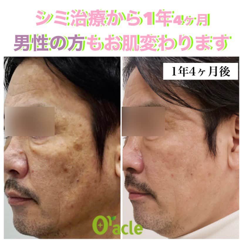 オラクル美容皮膚科東京新宿院さんのインスタグラム写真 - (オラクル美容皮膚科東京新宿院Instagram)「《シミ治療開始から1年4ヶ月》 40代男性。 YAGレーザー2回＋ルメッカ6回  シミ治療もなかなか長期戦でしたが、最終的に目立つ部分はピコYAG2回でほぼ分からなくなりました👏  先にルメッカを続けたことで、お肌全体に艶が出て肌質が改善❄️  お肌変わられたのがお会いしても毎回驚くほどです。 お肌が白く綺麗に整えられ、ご本人も大変満足されております👏  【治療法】 ☑️ルメッカで6回（2019年） ☑️ピコスポット2回（2020.3月、2020.10月） ﻿ 【料金】 ☑️ルメッカ トライアル　顔全体　25,000円（税抜）﻿ 通常　顔全体　30,000円（税抜）﻿  ☑️ピコスポット　別途麻酔代 初回　1cm×1cm  13,000円（税抜） ※再生テープ、ハイドロキノンつき  1cm×1cm  10,000円（税抜） ※再生テープ別  ⏰ダウンタイム﻿ ピコスポットは施術後シミが浮き上がり瘡蓋になります。﻿ 1週間肌色のテープを貼ってすごします。﻿ テープの上からメイク可能です。﻿ 瘡蓋は1週間〜10日かけて自然にはがれます。﻿ ﻿ ⚠️リスクなど﻿ ピコスポットは施術中痛みがありますので、麻酔をして施術を行います。﻿ ﻿  #メンズ美容　#シミ治療　#シミ取り #ルメッカ　#ピコスポット　#シミ取りレーザー #オラクル振り返り　#オラクルシミ症例」12月24日 10時10分 - oraclejp
