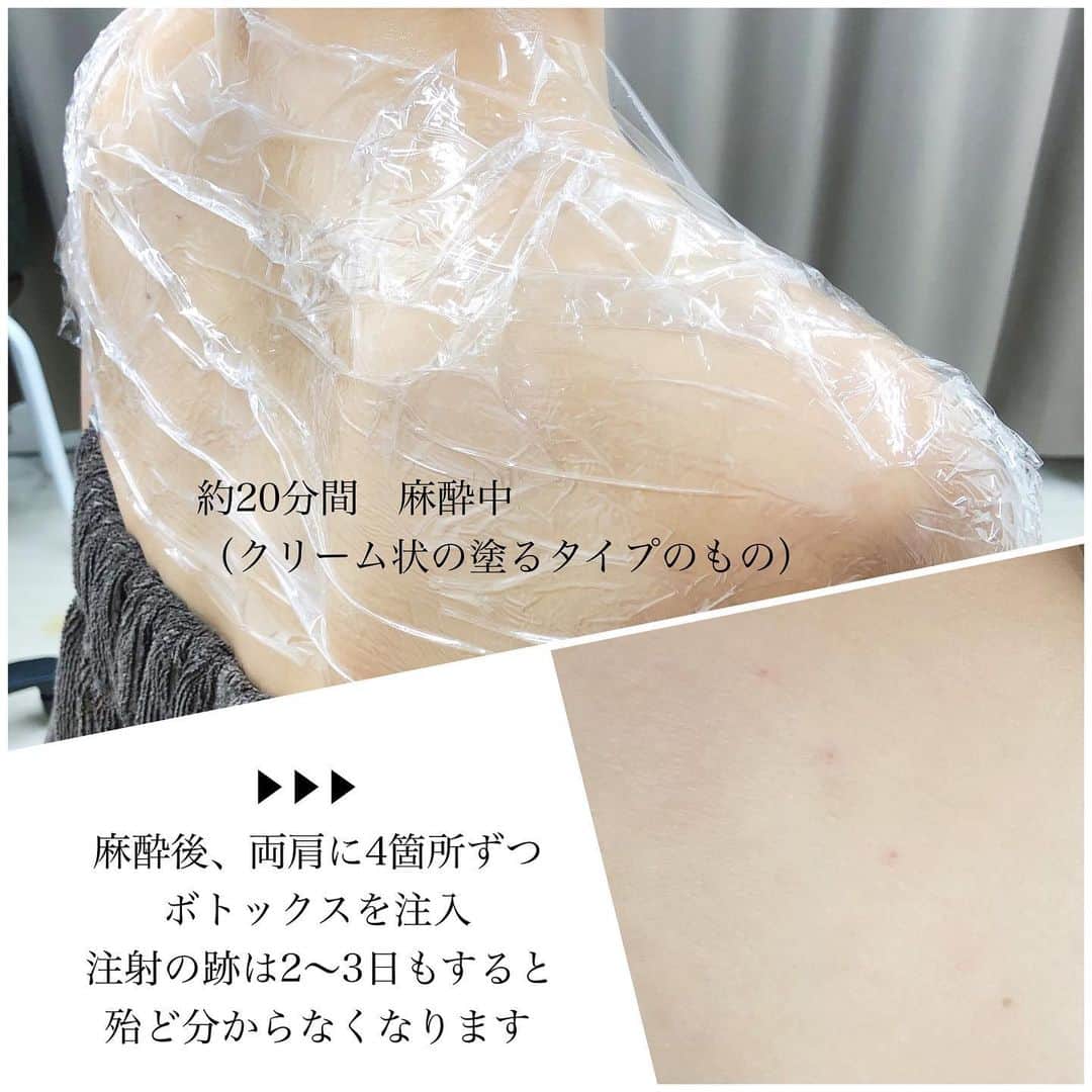 a_k_i_n_aさんのインスタグラム写真 - (a_k_i_n_aInstagram)「▶︎▶︎肩ボトックス 実際に受けてみて...  注射を刺す時よりも液を入れる時に 痛みを感じますが我慢出来ないほどでは なかったです☺️ 施術後は肩が何となくダルい感じで 違和感がありましたが、10日程すると そのダルさもなくなり肩の詰まりが 取れたようなスッキリ感を実感😌 2週間経った頃には見た目にもハッキリと 効果を感じることが出来ましたよ♡ 目立った副作用は特にありませんでした🙆‍♀️  本当に肩こりがひどくて自分の首が どんどん埋まっていくような感覚だったので このスッキリ感はたまらなく嬉しい😢❤️  ボトックスは打ち過ぎると耐性が 出来てしまい効果が減弱してしまうので 適切な注入量、間隔を守ることが大切 繰り返しボトックスを打つ事で 効果をより実感出来るそうなので 間隔を空けてしばらく続けていきたいなと 思っています☺️  今回私は @tcbshinyokohama  の真鍋先生　@tcb_manabe に施術して頂きました🤗  参考になりますように、、🎄  #肩ボトックス#肩凝り解消#ボトックス注射#美容外科」12月25日 22時56分 - lucky02181014