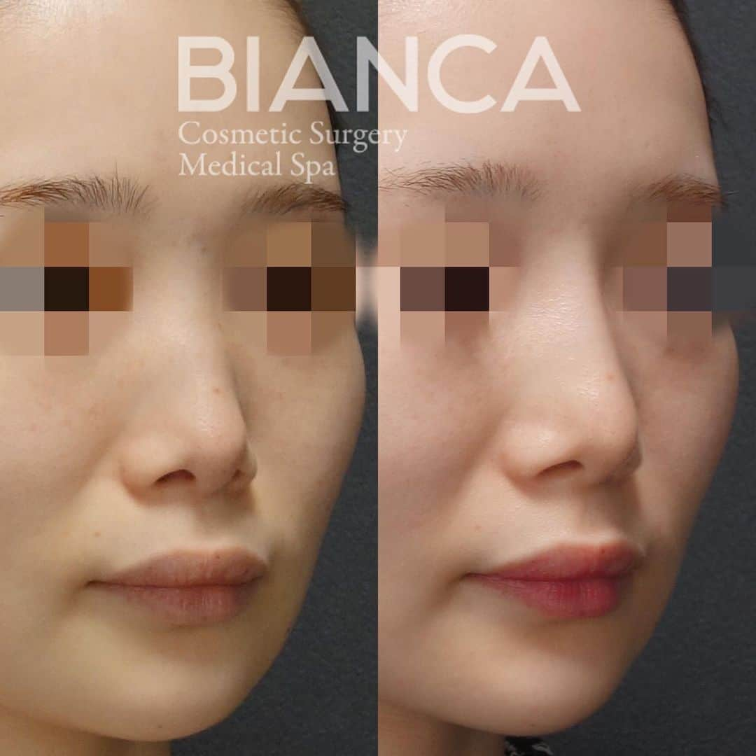 辻沢由有（BIANCA CLNIC 表参道院 院長）さんのインスタグラム写真 - (辻沢由有（BIANCA CLNIC 表参道院 院長）Instagram)「【鼻筋を通す✨】﻿ ﻿ ✔︎元のお鼻に合うように自然な高さのプロテーゼ﻿ ✔︎鼻先は鼻尖縮小で土台もキュッと細くしています☺️﻿ ﻿ 左 手術前﻿ 右 術後3ヶ月﻿ ﻿  鼻尖縮小 348,000円 ﻿ 鼻プロテーゼ 348,000円﻿ 🤕 ギブス固定:72時間 抜糸:1週間後﻿ 😷 腫れ・内出血: 10日前後 ﻿ ﻿ ﻿ ⚠️ご予約の際は﻿ 『Dr Yuu（辻沢）のインスタ見た』の一言をお願いします👩‍⚕️✨﻿ ﻿ 📍BIANCA CLINIC ﻿ ✔︎表参道院﻿ 03-6433-5994﻿ 東京都港区南青山5-11-10  南青山511ビル 2F﻿ ✔︎銀座院﻿ 03-6263-2690 ﻿ 東京都中央区銀座1-5-6 銀座レンガ通り福神ビル 4F﻿ 診療時間 10:00～19:00﻿ 年中無休（年末年始を除く）﻿ ﻿ #beauty #plasticsurgery #cosmeticsurgery #liposuction #threadlift #threadlifting #antiaging #美容外科 #美容皮膚科 #美容整形 #プチ整形 #整形 #美魔女 #鼻整形 #耳介軟骨移植 #鼻尖縮小 #鼻プロテーゼ #鼻ヒアルロン酸 #韓国整形 #オルチャンメイク #biancaclinic #ビアンカクリニック #dryuu鼻 #フォローミー #followme」12月28日 17時28分 - i_am_yuu__