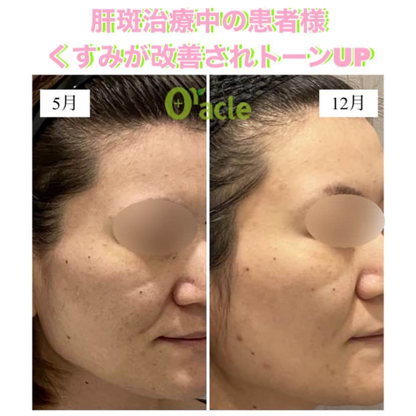 オラクル美容皮膚科東京新宿院さんのインスタグラム写真 - (オラクル美容皮膚科東京新宿院Instagram)「《今年肝斑治療を開始された患者様》 治療法はピコトーニング（再生管理セット）  現在も治療中です。 📷写真は2回目後→6回治療後 7ヶ月目の写真です。 トーニングを続けていることで、お肌全体がトーンアップして、くすみが改善されてお肌全体が綺麗になっていますね👏 ﻿ 【料金】 ☑️ピコトーニング 顔全体　1回　32,000円（税抜）﻿ ※コース﻿割あります。  ☑️再生管理 1回　10,000円（税抜） ※レーザー治療には再生管理のセットが効果的です  ⚠️リスクなど﻿ ピコトーニングは殆ど方はダウンタイムはなく、稀に直後赤み、痒みが出る場合があります。  ﻿  #ピコトーニング　#シミ治療　#シミ取り #トーニング　#肝斑治療　#肝斑 #ピコスポット　#シミ取りレーザー #オラクル振り返り　#オラクル症例」12月29日 9時43分 - oraclejp