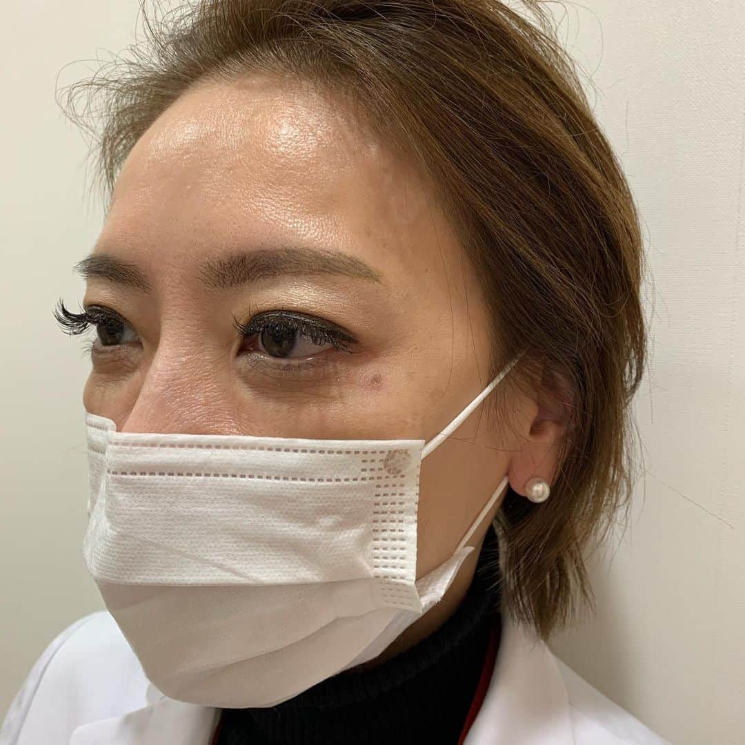 西川史子さんのインスタグラム写真 - (西川史子Instagram)「シロノクリニックで大野先生に 涙ボクロを取ってもらいました❗️ 結果は1か月後にご報告します。 ＃シロノクリニック#ホクロ除去」12月29日 17時22分 - dr.ayako_nishikawa