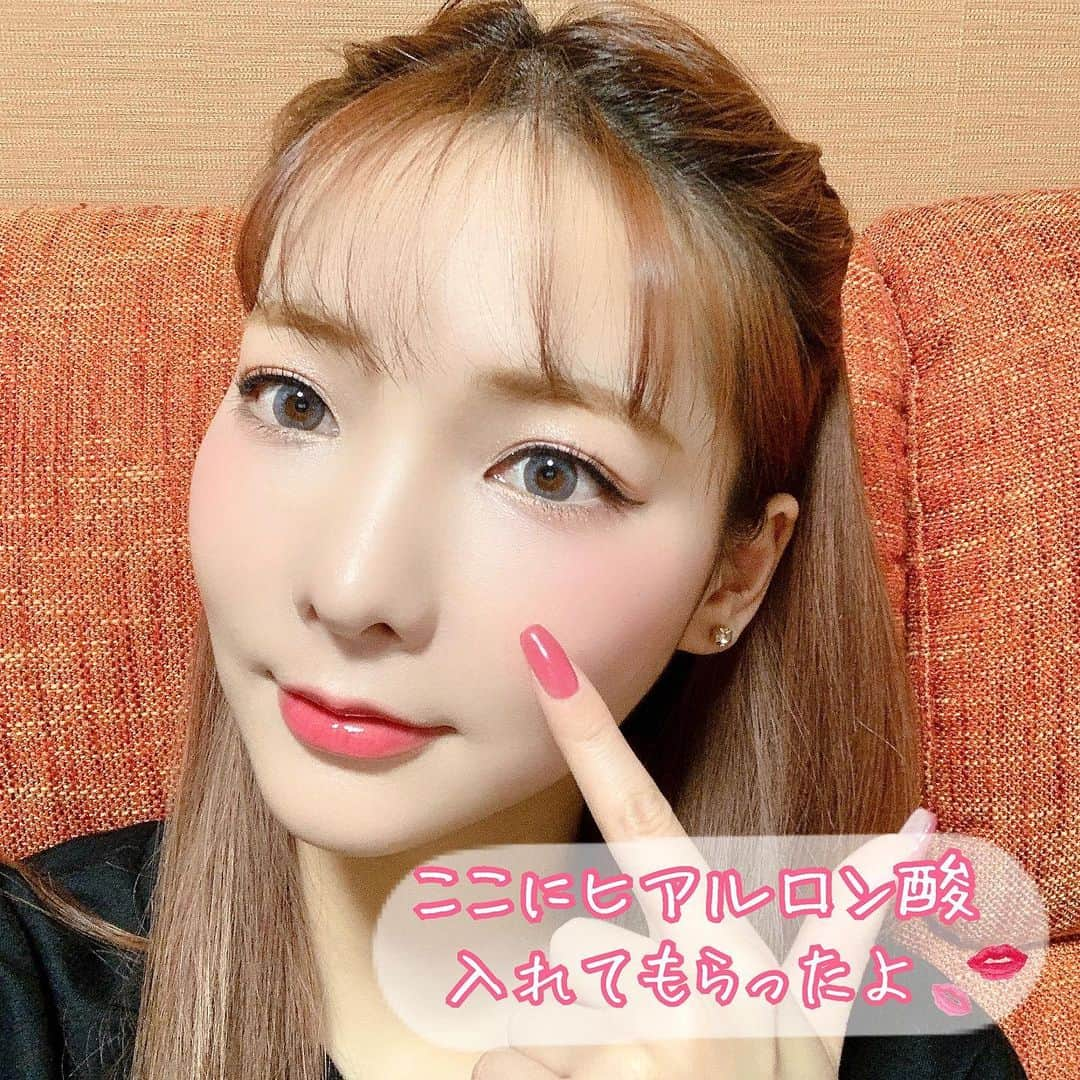 LISA minemuraさんのインスタグラム写真 - (LISA minemuraInstagram)「🌹 みなさま動画を見てくれましたかっ？🥺💓 へこみがふっくらしてる😭✨ 若返って大満足💖💖💖 #junclinic #ジュンクリニック #ヒアルロン酸 #若返り 🌹#ワインカラー #キャンマジ #ルナナチュラル #アクア  #ロムアンド #クリオ #셀스타그램 #얼스타그램 #카메라 #촬영 #ヘアカラー  #ヘアスタイル #アッシュベージュ  #ベージュブラウン #エクステ #カラコン  #メイク #キャバ嬢 #キャバクラ  #長野 #長野市 #権堂  #りーみ #長野モデル #長野市モデル #長野県モデル」12月30日 19時49分 - lisa.minemura