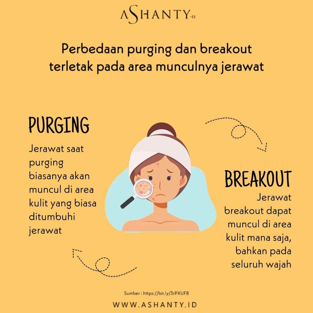 ASHANTY BEAUTY CREAM OFFICIALさんのインスタグラム写真 - (ASHANTY BEAUTY CREAM OFFICIALInstagram)「Hi ladies, masih banyak banget nih yang bingung apasih perbedaan purging dan breakout ? Jadi Perbedaan purging dan breakout terletak pada area munculnya jerawat.  Jerawat saat purging biasanya akan muncul di area kulit yang biasa ditumbuhi jerawat. Sedangkan, jerawat breakout dapat muncul di area kulit mana saja, bahkan pada seluruh wajah.  _________________________________ Informasi dan pemesanan : WA: 085781140354 WA: 087778489900 WA: 081287388885 WA: 081293823950 FAST RESPONS CLICK LINK yang ada di Bio IG @ashantyid  _________________________________ #creamwajag #beauty #cosmetics #brandlocal #skincare #skincarelocal #thehermansyah #beautyvlogger #beauty #kosmetikmahal #ashantyid #keluargaasix #ashantyhermansyah #mua」1月5日 20時55分 - ashanty.store