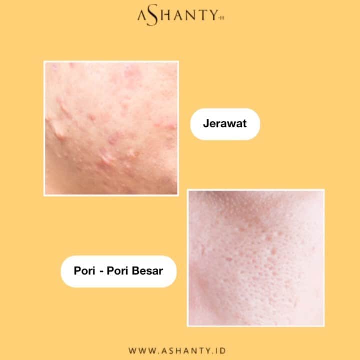 ASHANTY BEAUTY CREAM OFFICIALのインスタグラム：「Komedo dan pori - pori besar sering menghantui dan membuat kurang percaya diri. Atasi masalah wajah kusam, berminyak, berjerawat, komedo dan pori - pori besar menggunakan rangkaian Acne Cream Series by @ashantyid 💛  _________________________________ Informasi dan pemesanan : WA: 087778489900 WA: 081287388885 WA: 085781140354 WA: 081293823950 FAST RESPONS CLICK LINK yang ada di Bio IG @ashantyid  _________________________________ #creamwajag #beauty #cosmetics #brandlocal #skincare #skincarelocal #thehermansyah #beautyvlogger #beauty #kosmetikmahal #ashantyid #keluargaasix #ashantyhermansyah #mua」