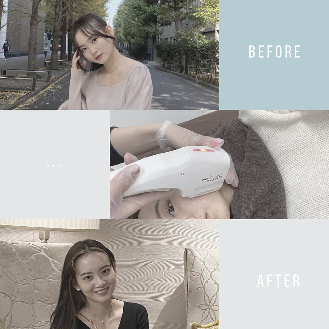 青山舞莉のインスタグラム：「東京中央美容外科渋谷東口院 @tcb_shibuyahigashi HIFU(ハイフ)•ソノクイーンの経過観察に来ました。  新年早々効果がわかりやすく見えたからとても嬉しいな🤍  塩満先生　@tcb_shiomitsu も他のスタッフさんも優しかった😇　アフターに本当に満足してる！これで2021年良い年になりますよーに！  #リフトアップならTCB東京中央美容外科 #美容整形ならTCB東京中央美容外科 #東京中央美容外科 #東京中央美容外科渋谷東口院 #美容外科 #塩満院長 #塩満ドクター #渋谷東口　#塩満恵子 #ソノクイーン #ソノクイーンなら #ハイフ #HIFU #リフトアップ #PR」