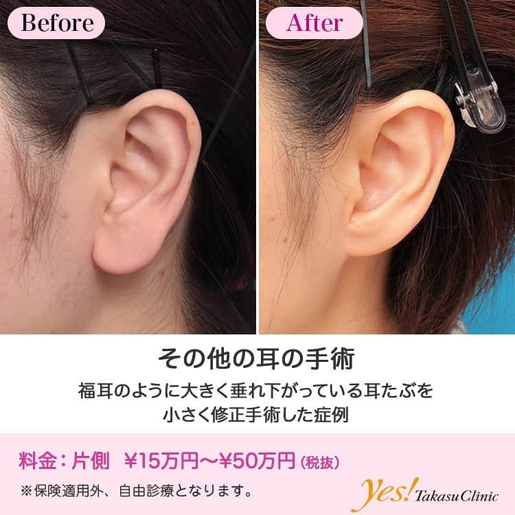 高須クリニックのインスタグラム：「👨🏻‍⚕️高須幹弥医師からのコメント✨⠀ 30代女性の患者様で、大きな耳たぶが悩みで来院されました。 診察させていただいたところ、耳たぶのサイズが平均よりかなり大きめで、福耳のように垂れ下がっていました。 福耳は「お金が貯まる」「お金持ちなる」といわれており、本来縁起のよいものなのです。 しかし、福耳の人は色々な人から、「耳たぶが大きいねー」「福耳だねー」などと言われることになります。 そのようなことを言う人のほとんどは悪気がないのですが、たくさんの人に言われると、「また言われた」「いちいち耳たぶのこと言わないでほしい」と思い、いつしか福耳であることが大きなコンプレックスになります。 この症例写真をみて、「別に手術しなくていいのでは？」と思う人もいると思いますが、本人は想像以上に悩んでいることが多いです。 この患者様は傷跡が目立たないように、耳たぶの付け根で余分な皮膚、組織を切除し、丁寧に縫合しました。 術後はスマートでシャープな耳たぶになりました。 ---------------------------------------------------- 🌈料金✨⠀ ●その他の耳の手術 片側 ¥150,000~500,000【東京、横浜、名古屋、大阪】 ---------------------------------------------------- ⚠️リスク・副作用・合併症✨⠀ ●その他の耳の手術 手術後に処方する抗生剤や痛みどめによるアレルギー症状 仕上がりのわずかな左右差（完璧なシンメトリーは不可） --------------------------------------------------- 😊施術についての詳細✨⠀⠀ https://www.takasu.co.jp/photo/mimiother10.html ---------------------------------------------------- 📞ご予約・お問い合わせ✨⠀ 0120-5587-10⠀ https://www.takasu.co.jp/cgi-bin/form/contact.cgi ※症例写真や施術に関するご質問なども上記までお願い致します。 ---------------------------------------------------- #その他の耳の手術 #耳の手術 #耳たぶを小さくしたい #福耳 #シャープな耳たぶ  #皮膚 #美容 #美肌 #エイジングケア #美容整形 #美容外科 #美容クリニック #美容好き #美容皮膚科 #モニター #モニター募集 #高須クリニック #高須クリニック名古屋 #高須幹弥 #整形したい #プチ整形 #症例 #症例写真 #可愛くなりたい #可愛い #美人」
