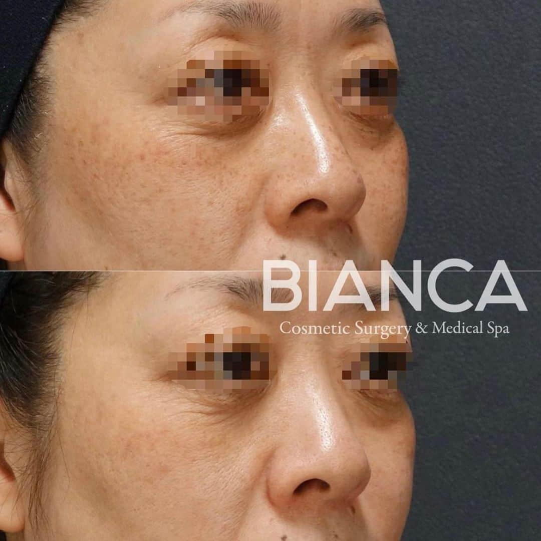 辻沢由有（BIANCA CLNIC 表参道院 院長）さんのインスタグラム写真 - (辻沢由有（BIANCA CLNIC 表参道院 院長）Instagram)「【たったの1回で🌟】﻿﻿﻿﻿﻿﻿﻿﻿﻿﻿﻿﻿﻿ ﻿﻿﻿﻿ 上 治療前﻿﻿﻿﻿﻿﻿﻿﻿﻿﻿﻿﻿﻿﻿ 下 スポット照射 1回後﻿ ﻿ ピコシュアによるスポット照射💥﻿ 1回でおおまかなシミが綺麗になりました‼️﻿ ﻿ 取りきれなかったシミや色むらは﻿ このあとのトーニング治療により﻿ どんどん改善していきます❣️﻿ ﻿﻿﻿﻿﻿﻿﻿ 1人で悩んでいる時間はもったいないです❗️😵⭐﻿﻿﻿﻿﻿﻿﻿﻿﻿ 気になる方は是非カウンセリングにお越しください☺️️﻿﻿﻿﻿﻿﻿﻿﻿﻿﻿﻿﻿ ﻿﻿﻿﻿﻿﻿﻿﻿﻿﻿﻿﻿﻿ 💴 ピコスポット 全顔 98,000円﻿﻿﻿﻿﻿﻿﻿﻿﻿﻿﻿﻿﻿﻿ 💉麻酔: 表面麻酔﻿﻿﻿﻿﻿﻿﻿﻿﻿﻿﻿﻿﻿﻿ 😷DT: シミの黒浮き1週間程度﻿﻿﻿﻿﻿﻿﻿﻿﻿﻿﻿﻿﻿﻿ ⚠️リスク: 色素脱失・色素沈着・水泡形成など﻿﻿﻿﻿﻿﻿﻿﻿﻿﻿﻿﻿﻿ 💴ピコトーニング 14,800円/回﻿﻿﻿﻿﻿﻿﻿﻿﻿﻿﻿﻿﻿ ﻿﻿﻿﻿﻿﻿﻿﻿﻿﻿﻿﻿﻿﻿ 🉐モニター大募集中‼️ ﻿﻿﻿﻿﻿﻿﻿﻿﻿﻿﻿﻿﻿﻿ ⚠️ご予約の際は﻿﻿﻿﻿﻿﻿﻿﻿﻿﻿﻿﻿﻿﻿ 『Dr Yuu（辻沢）のインスタ見た』の一言をお願いします👩‍⚕️✨﻿﻿﻿﻿﻿﻿﻿﻿﻿﻿﻿﻿ ﻿﻿﻿﻿﻿﻿﻿ 📍BIANCA CLINIC﻿﻿﻿﻿﻿﻿﻿﻿﻿﻿﻿﻿ ﻿﻿﻿﻿﻿﻿﻿﻿ ✔︎表参道院﻿﻿﻿﻿﻿﻿﻿﻿﻿﻿﻿﻿ 03-6433-5994﻿﻿﻿﻿﻿﻿﻿﻿﻿﻿﻿﻿ 東京都港区南青山5-11-10  南青山511ビル 2F﻿﻿﻿﻿﻿﻿﻿﻿ ✔︎銀座院﻿﻿﻿﻿﻿﻿﻿﻿﻿﻿﻿﻿ 03-6263-2690 ﻿﻿﻿﻿﻿﻿﻿﻿﻿﻿﻿﻿ 東京都中央区銀座1-5-6 銀座レンガ通り福神ビル 4F﻿﻿﻿﻿﻿﻿﻿﻿ ﻿﻿﻿﻿ 診療時間 10:00〜19:00﻿﻿﻿﻿﻿﻿﻿﻿﻿﻿﻿ 年中無休（年末年始を除く）﻿﻿﻿﻿﻿﻿﻿﻿﻿﻿﻿﻿﻿﻿  #plasticsurgery #cosmeticsurgery  #美容外科 #美容皮膚科 #美容整形 #プチ整形 #美肌 #美魔女 #美容 #アンチエイジング  #picosure #ピコシュア #ピコトーニング #ピコフラクショナル #ビアンカクリニック #dryuu #シミ取り #そばかす #シミ治療 #dryuu肌 #ソバカス #スキンケア #美白 #biancaclinic #ビアンカクリニック #レーザートーニング #モニター募集 #モニター募集中 #followｍe #フォローミー」1月8日 7時42分 - i_am_yuu__