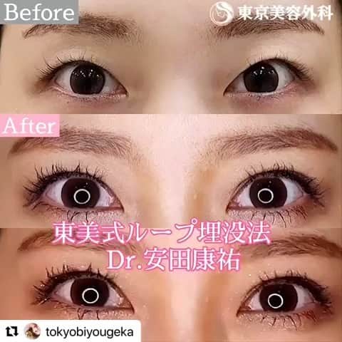 東京美容外科公式のインスタグラム：「福山院長、安田先生の症例です☺️❤️ バレないナチュラル二重に仕上がっております✨ #Repost @tokyobiyougeka with @make_repost ・・・ @ksk.1209 福山院院長安田ドクターによる埋没二重✨✨ ㅤㅤㅤㅤㅤㅤㅤㅤㅤㅤㅤㅤ モニターも募集中💁‍♀️💁‍♀️💁‍♀️ 是非お問い合わせくださいませ✨  通常☆2点留め両目13万円(税抜) モニターの場合こちらの価格から最大30〜50%OFF☺️ ※モニター審査あり、人数限定 ㅤㅤㅤㅤㅤㅤㅤㅤㅤㅤㅤㅤ #東京美容外科 #モニター募集 #埋没二重 #埋没二重術 #埋没二重ダウンタイム #美容外科 #二重整形 #二重メイク #二重 #アイプチ卒業」