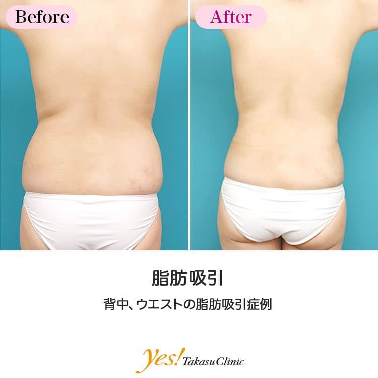 高須クリニックのインスタグラム：「👨🏻‍⚕️高須幹弥医師からのコメント✨⠀ 20代女性の方です。 背中~ウエストにかけてたくさん脂肪がついており、背中のお肉がたっぷりつまめて、パンツの上にウエストのお肉が乗っかっている状態でした。 脂肪吸引で1500ccの脂肪を吸い取りました。 術後はウエストにくびれができ、思いっきりつまめていたお肉がほとんどつまめなくなりました。 脂肪吸引は脂肪の貯蔵庫である脂肪細胞そのものを取り除いてしまうため、リバウンドすることもなく効果が半永久に続きます。 ---------------------------------------------------- 🌈料金✨⠀ ●脂肪吸引 両ウエスト（側腹部） ¥200,000~300,000 / 下腹部（へそ下おなか） ¥380,000~570,000 / 上腹部 ¥200,000~300,000 / 両上腕部（二の腕） ¥280,000~420,000 / 両大腿（内側・外側・前面・後面・ひざ周り） 各 ¥380,000~570,000 / ふくらはぎ ¥380,000~570,000 / 臀部（おしり） ¥380,000~570,000 / ホホ、あご 各 ¥280,000~420,000 / 背中 ¥380,000~570,000【東京、横浜、名古屋、大阪】 ※脂肪吸引は取る脂肪の量によって料金が変わります。詳しくは診察時にご確認ください。 ---------------------------------------------------- ⚠️リスク・副作用・合併症✨⠀ ●脂肪吸引 皮膚のたるみ・不自然な凹凸や段差（脂肪を吸引しすぎた場合） 内出血（術後） 仕上がりのわずかな左右差（完璧なシンメトリーは不可） カニューレ挿入口の傷跡が肥厚性瘢痕やケロイドになる可能性 --------------------------------------------------- 😊施術についての詳細✨⠀⠀ https://www.takasu.co.jp/photo/shibokyuin58.html ---------------------------------------------------- 📞ご予約・お問い合わせ✨⠀ 0120-5587-10⠀ https://www.takasu.co.jp/cgi-bin/form/contact.cgi ※症例写真や施術に関するご質問なども上記までお願い致します。 ---------------------------------------------------- #脂肪吸引 #背中の脂肪吸引 #ウエストの脂肪吸引 #ウエストにくびれ  #皮膚 #美容 #美肌 #エイジングケア #美容整形 #美容外科 #美容クリニック #美容好き #美容皮膚科 #モニター #モニター募集 #高須クリニック #高須クリニック名古屋 #高須幹弥 #整形したい #プチ整形 #症例 #症例写真 #可愛くなりたい #可愛い #美人」
