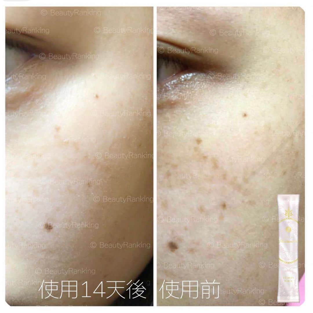 のインスタグラム：「超感激超感謝美美客人～～超爆誇張 14天效果回圖💛 #moa好評  一日2條 好快見到效果💛 個個熟客都對我地咁好！感激感謝一直支持一直鼓勵💛   ⚜️MOA 貴婦奢華系列⚜️ ⚜️ 袪斑極緻美白飲 ⚜️🇯🇵日本製 ETERNITY WHITE  袪斑每日3條會係最快速！ 從此不需要再用濾鏡，肌膚白裏透光，水感透白，再沒瑕疵。 美白產品一向只需成分上分析，含量及實際功效。 抗自由基：GliSODin®法國專利香瓜萃取 抗糖化：櫻花萃取 抗光老化 ：蕨類植物抽出物 抗黑色素沈積：L 半胱氨酸 抗色斑黃褐斑：梔子花取出的藏紅花酸 抗暗沈氧化：谷胱甘肽 超重磅明星成分： ⚜️GliSODin®法國專利香瓜萃取⚜️ 全世界第一個經臨床證實口服有效『可以經由消化系統吸收的超氧化歧化酶SOD』 專利小麥蛋白包覆技術，真正吸收，不會因胃酸破壞失去活性。 法國製造，世界8項功效專利及科學和臨床研究。 GliSODin®抗氧化能力為松樹皮的400倍,蝦紅素的20倍, 效用為維生素Ｃ的 8,000 倍，啓動自我恢復力，可有效抵御自由基的侵害，並可有效防止老化，減少老化痕跡。 外用護膚的最強對抗自由基C60富勒烯可以使用C60系列，但內服用護膚的最強對抗自由基就會是GliSODin® 超氧化物歧化酶。 ⚜️ 日本櫻花萃取 專利櫻花萃取－咖啡酰葡萄糖及槲皮素糖苷 使用專利櫻花萃取30日後，肌膚明顯保濕度提升，減少水分流失肌膚炎症減少，總皺紋亦減少8%。 有顯著的抗糖化作用，減少「糖化終產物（AGEs）」的產量，擊退暗黃膚色， 維持肌膚年輕鎖水能力及光滑有彈性，糖化反應與年齡膚質都沒有關係，任何年齡都需面臨的問題，所以肌膚糖化，就會導致老化！ 肌膚領域的糖化作用，過多的糖分就會附著在膠原蛋白上，使膠原蛋白斷裂或紊亂，導致肌膚鬆弛、水分流失、失去緊緻度、膚色變暗沉、皺紋變多。 ⚜️L-半胱氨酸（日本產 ） 抑制真黑色素生產的一種胺基酸，使肌膚變得更白晢明亮。 透過調節肌膚更新週期，加速黑色素代謝，令面色剔透亮白，減淡色斑。 ⚜️ 谷胱甘肽（圓酵母精華）日本產  穀胱甘肽GSH是一種三胜肽，100%天然發酵生產，萃取至98%高純度之「圓酵母精華」，100%小腸直接吸收；是人體重要的抗氧化物，具有阻斷黑色素生成的作用。 令肌膚重新透出光感淨白肌能使肌膚白皙透亮，打造亮白肌，因此，又被稱為『吃的美白針』。 日本官方證實：口服補充穀胱甘肽的確可以被人體吸收利用、提高體內穀胱甘肽濃度 證實穀胱甘肽可抑制皮膚黑色素生成，使皮膚亮白，同時也具有改善皮膚皺紋、皮膚彈性和斑點的效果。 ⚜️ 水龍骨(polypodium leucotomos)的蕨類植物萃取 主要防光老化，預防暴露於陽光紫外線下過久所形成的色斑和皺紋。  實驗報告顯示能有效預防因紫外線照射皮膚所引起的傷害,如深層細胞的損傷所導致皮膚出現光老化現象的 DNA 損壞、皺紋、鬆弛皮膚以及皮膚發炎等。 ⚜️ 梔子花萃取的藏紅花酸（日本產 ） 日本臨床實證： 使用專利梔子花萃取7.5mg 2個月後，全臉色斑減淡22%，色斑面積減少17% 於接受紫外光照射之4小時前，使用專利梔子花萃取15mg ，經24小時照射後，紅斑產生抑制20%，紫外線傷害引發之炎症及傷害。 特別適合： 追求美白與美肌兼顧的您 　 希望在炎夏得到美白護理的您 　 受膚色暗沈困擾的您 　 擔心出現色斑及雀斑的您　 由體內極速給予肌膚透明感  追求全身透亮美白的您 不適合使用外用美白產品的您 一般美白丸已不能滿足到的您 曬黑之後難以回復原狀的您 基礎防護：1日1包 建議：1日2包 （早晚各一） 追求最快速卓越效果：1日3包 （早午晚各一） 建議早上服用可充分發揮配方其 抗氧化防止紫外光傷害之作用 如進行日常早上活動請預早半小時使用。 如進行暴曬活動最好預早4小時，一次過飲用2包，有效抑制黑色素形成，不易曬黑及曬傷。 成分：每包  建議：1日2包 （早晚各一） L 半胱氨酸：120mg GliSODin®法國專利香瓜萃取：115mg 谷胱甘肽（圓酵母精華）: 125mg （美白針主要成份） 日本櫻花萃取：50mg 梔子花取出的藏紅花酸：7.5mg  蕨類植物抽出物：125mg ⚜️MOA 貴婦奢華系列⚜️ ⚜️ 袪斑極緻美白飲 ⚜️ ⚜️$599/28條  ⚜️$1078/56條 （9折） ⚜️$2037/112條 （85折） 見效時間視乎個人新陳代謝 年紀越大所需時間越長和色斑深淺程度 請給予耐性並必須每日使用足夠物理防曬 色斑越早處理越好 若色斑較淺色，即只是卡在表皮層 大約14至28日 黑色素便會開始顯著淡化 約兩個月便消退 若色斑較深色，即是根部已經卡在真皮層 需要更長時間 建議服用3個月或以上，效果最為理想 #moa好評 #modeofantoinette」