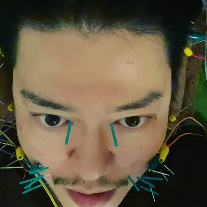 渋谷慶一郎のインスタグラム：「顔とアタマに打たれた大量の鍼には絶え間なく電気が流れてます。 The many acupuncture needles on my face and head are constantly receiving electric current.」