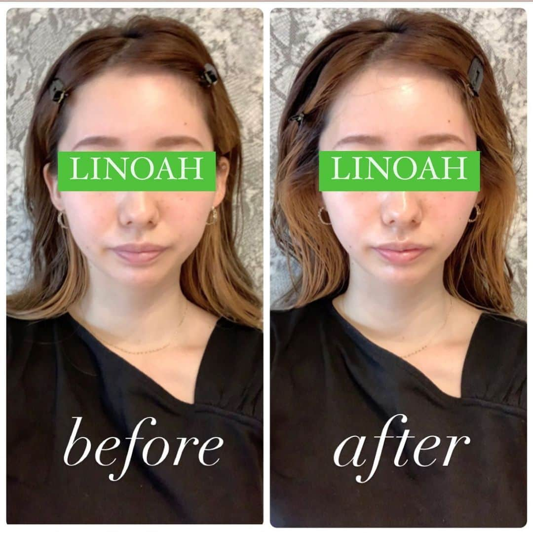 Beauty Salon LINOAHさんのインスタグラム写真 - (Beauty Salon LINOAHInstagram)「﻿ ﻿ ３D HIFU（ハイフ）﻿ ⭐️全顔お試し9800円⭐️﻿ 1回9800円でお受け頂けます！！﻿ ﻿ ご興味がある方は是非、ご予約お問い合わせいただければと思います。﻿ ﻿ ホットペッパービューティーよりご予約可能です。﻿ ﻿ 脱毛・フェイシャルBeautySalon　LINOAH　　　　　　　　﻿ 大阪梅田の脱毛・フェイシャル完全予約制のプライベートサロン　　﻿ 男女　性別問わずご利用頂けます。﻿  ﻿  ﻿ 【アクセス】﻿  阪急 梅田駅茶屋町口 徒歩 5分﻿ 大阪市北区鶴野町4-11　朝日プラザ914﻿ ﻿  ﻿ 【営業時間】﻿ 平日　11:00～22:00（最終受付21：30）﻿ 土日祝　11:00～20:00（最終受付19：30）﻿ ※完全予約制となっております。﻿  ﻿ 【定休日】﻿ 毎週木曜日﻿  ﻿ 🌱ご予約・ご相談はこちらへ﻿ 📞06-6110-5067 ﻿ ﻿ ﻿ #大阪 #梅田 #脱毛 #メンズ脱毛 ﻿ #レディース脱毛 #フェイシャル #エステ #beautysalonlinoah ﻿ #ビューティーサロンリノア ﻿ #プライベートサロン ﻿ #フォトフェイシャル ﻿ #男性 #女性 #lgbt ﻿ #安心 #美肌 #美白 #しみ #シワ ﻿ #ニキビ #ニキビ跡 #イオン導入　﻿ #リフトアップ #小顔 #ハイフ#HIFU﻿ #ヒゲ  #青ひげ #カミソリ負け #美意識」2月3日 15時34分 - beautysalon_linoah