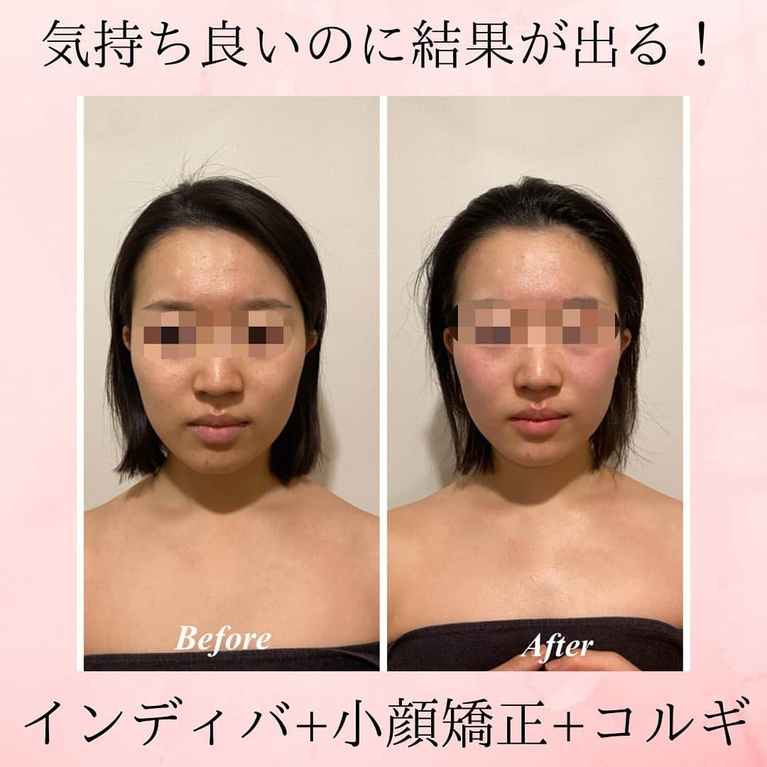 Eternal Total Beauty Salonのインスタグラム：「【ビフォーアフター】  こちらは1回での結果です💆‍♀️  嬉しいご感想もありがとうございます🥺♡  インディバで温め細胞活性&むくみを取り 小顔矯正で広がった骨格を整えて左右対称に！  最後はコルギで老廃物をリンパに流しリフトアップ✨  1回でも変わりますが、最低5回継続して頂くと定着して戻りにくくなりますよ☺️  みなさま気付くとスヤスヤ落ちてます😴　  お顔が変わるだけではなくサロンに居てくださる間はリラックス&癒しの時間になれば嬉しいです💕  ＊＊＊＊＊＊＊＊＊＊＊＊＊＊  恵比寿駅西口徒歩4分♪ インディバエステ/小顔・痩身  営業時間　11:00〜21:00(19:00最終受付)  定休日　不定休  Tel 0364163830 お電話はつながり難い事が多いのでDMもしくはトップページの予約サイトから🙇‍♀️ 【@beautylian.111】  ＊＊＊＊＊＊＊＊＊＊＊＊＊＊  #インディバ  #インディバエステ  #インディバサロン  #インディバ専門店  #インディバ 東京 #小顔東京 #小顔 #コルギ  #小顔矯正 #ビフォーアフター #ビフォーアフター写真  #セルライト除去  #免疫力を高める  #結果の出るサロン #えらはり改善  #エラ張り解消  #左右差が整います  #むくみ防止  #浮腫み解消  #顔痩せ効果  #冷え性改善  #体質改善 #高周波 #美と健康 #リフトアップ #エニシーグローパック正規取扱店」