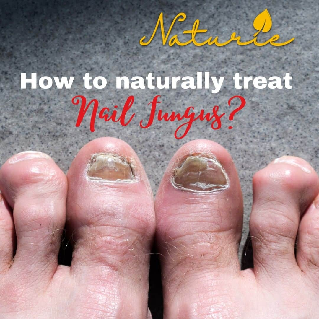 ナチュリエのインスタグラム：「Nail fungus is a yellow-ish spot under the tip of your fingernail or toenail. Nail fungus may cause your nail to discolor, thicken and crumble at the edge. . There is an easy way to treat them. You can use hypochlorous acid or tree tree oil. These two ingredients works wonder to help reduce the infection. . Make sure you dilute the tea tree first with carrier oil like Coconut Oil before applying on your toe nails.  . An easier way is to get Naturie Premium Tea Tree Spray at www.naturie.com.my. This spray contains hypochlorous water and tea tree oil, a perfect combination to help you combat your nail fungus.  . With this spray, all you have to do is spray at the effected area as and when it is required.」