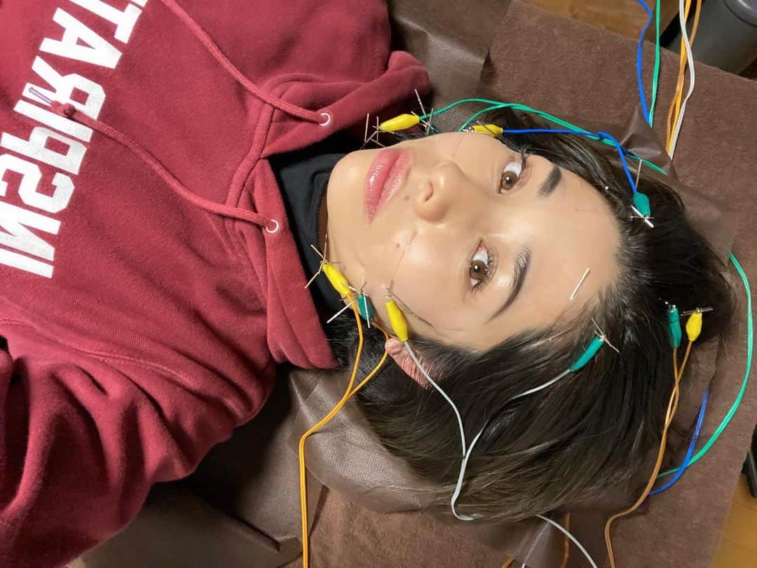 齋藤美波のインスタグラム：「🪡🪡🪡 シュールな図。笑 ・ 遅くなりましたが 今年初の美容鍼にやっと 行ってきました✨ ・ 先生にも寝た時のお肉の垂れ具合が 変わったと言われてニヤニヤ😚 でもそれは自分が一番変わったと 実感してる！ そして今回は頭が浮腫んでるって 言われましたー🤪 甘いものばかり食べてます？ って言われて、、、 バレてるー笑 ・ はい。最近甘いもんばっかです😇 体が欲してるんですもん。笑 注意を受けました！😜 そーやって指摘してくれるので 信頼出来る鍼師です😎 👨🏽‍⚕️ @amor_takeuchi  ・ 見た目は痛そうに見えるが 初めてやる人はちょっと怖いかもだけど やられてる間眠くなるほどの心地よさに 変わってくるよん🙌🏾 ・ 予約時に"美波の紹介で"って伝えれば ¥1000offになるので是非使ってね！ ・ 次は肩の凝りほぐしの治療と 美容鍼のセットで行くよ♥️🪡 もう鍼の虜🤍 ・ 💆🏽@amorchigasaki  ・ ・ #美容鍼#鍼灸サロン#茅ヶ崎#鍼治療#自律神経#浮腫#張り#艶#肌質改善 #茅ヶ崎#湘南 #chigasali#salon#beauty#amorchigasaki」