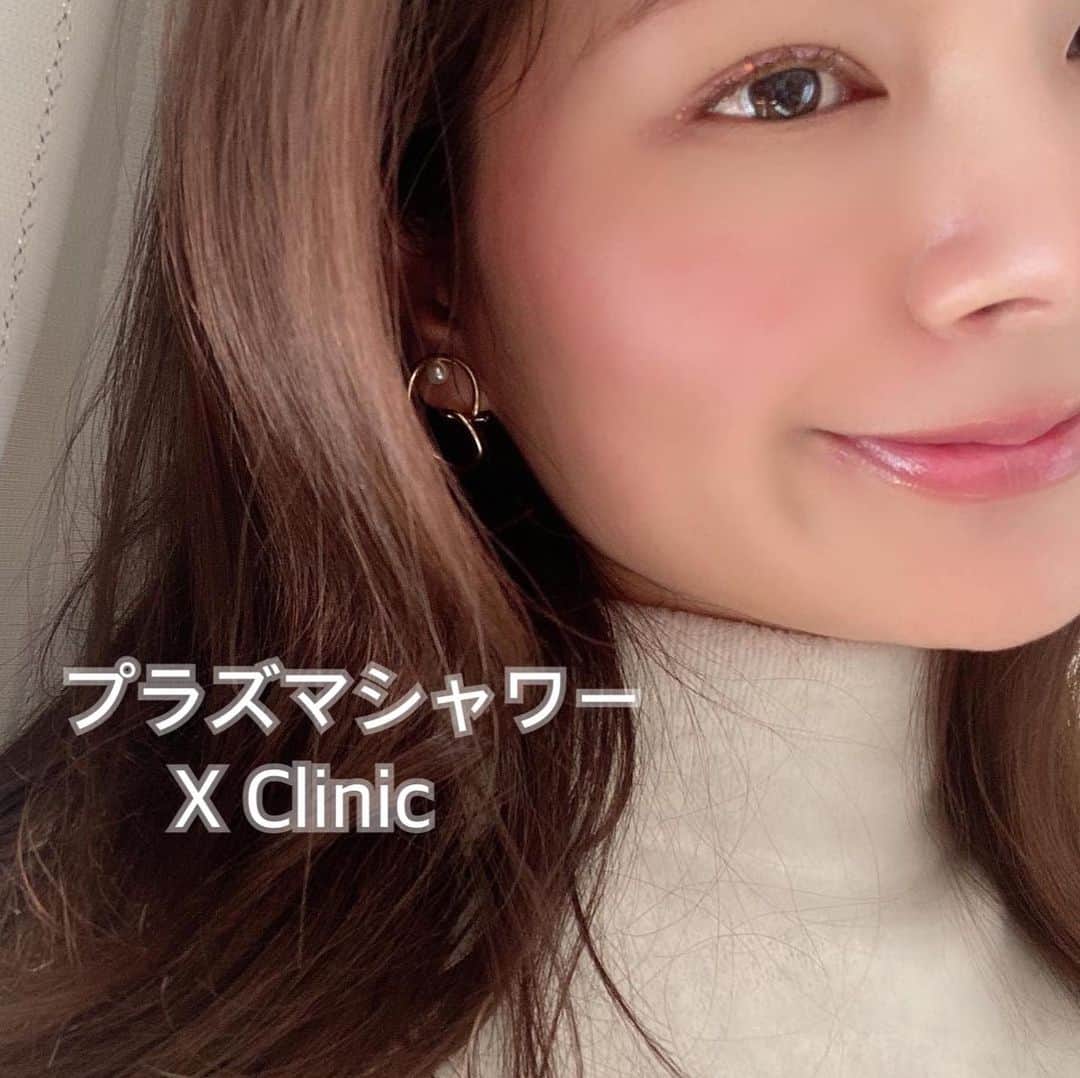 えりっこのインスタグラム：「X Clinicへ🤍 ⋆ ⋆ ちょこっと前の🙏 ⋆ 恵比寿駅の看板でよく見かけていてずっと気になっていた @x_clinic_ebisu 🤍 ⋆ 綺麗だなと思っていた　@dr.tomoko_sakai 酒井先生にお会いしたら実物が更に綺麗で可愛かった件🥺💓 ⋆ #プラズマシャワー を受けてきました♪♪ ⋆ Xclinic より引用 ⋆ 皮膚組織にダメージを与えることなく、強力な滅菌作用でニキビをはじめとするさまざまな皮膚トラブルを引き起こす細菌を排除します。 さらに真皮では、線維芽細胞を刺激することでコラーゲン・エラスチンの産生を促進し、肌のハリ・弾力の改善に効果が期待できます。 ⋆ ⋆ プラズマっていうのはイオン化した気体。 ⋆ いわゆる　#イオン導入 何度かエステなどでしたことはありましたがクリニックでは初めて！ エステのイオン導入より、効果が250倍と聞き驚きでした😳 ⋆  肌に栄養を浸透させるために、いつもは化粧水などを入れますが、 プラズマシャワーをすることで肌のさらに下の電気バリアを30分程度開放してくれることで、更に奥まで栄養を届けてくれるようです。 ⋆ ⋆ その間に純粋な栄養物質を導入してもらうのですが 私は今回　#トラネキサム酸　にして頂きました🤍 ⋆ 肌を鎮静してくれる効果があるそうなので♪ ちょうど小さいニキビが出来そうだったからこれにしてみました✨ ⋆ お値段は大体一万円くらい。✨ ⋆ ⋆ クリニックのお肌が綺麗なお姉さんはすごく頻繁にこの施術をして痛くなくて怖くなくてお気に入りなんです〜と言っていました ⋆ ⋆ #ダーマペン　みたいにがんばった・・！という感じはないけれど。笑 痛くもなく怖くもないのは確かにいい。😂😂😂 ⋆ ⋆ ちょっと気になるな、もうちょっと綺麗の底上げしたいな、って時にまた伺わせて頂こうと思います🥰🥰🥰 ⋆ ⋆ 追記。 クリニックがめちゃくちゃ綺麗です🤣🤣（swipe3枚目動画） ⋆ ⋆ ⋆  #エックスクリニック#Xクリニック#孫駿一郎#酒井知子#プラズマシャワー」
