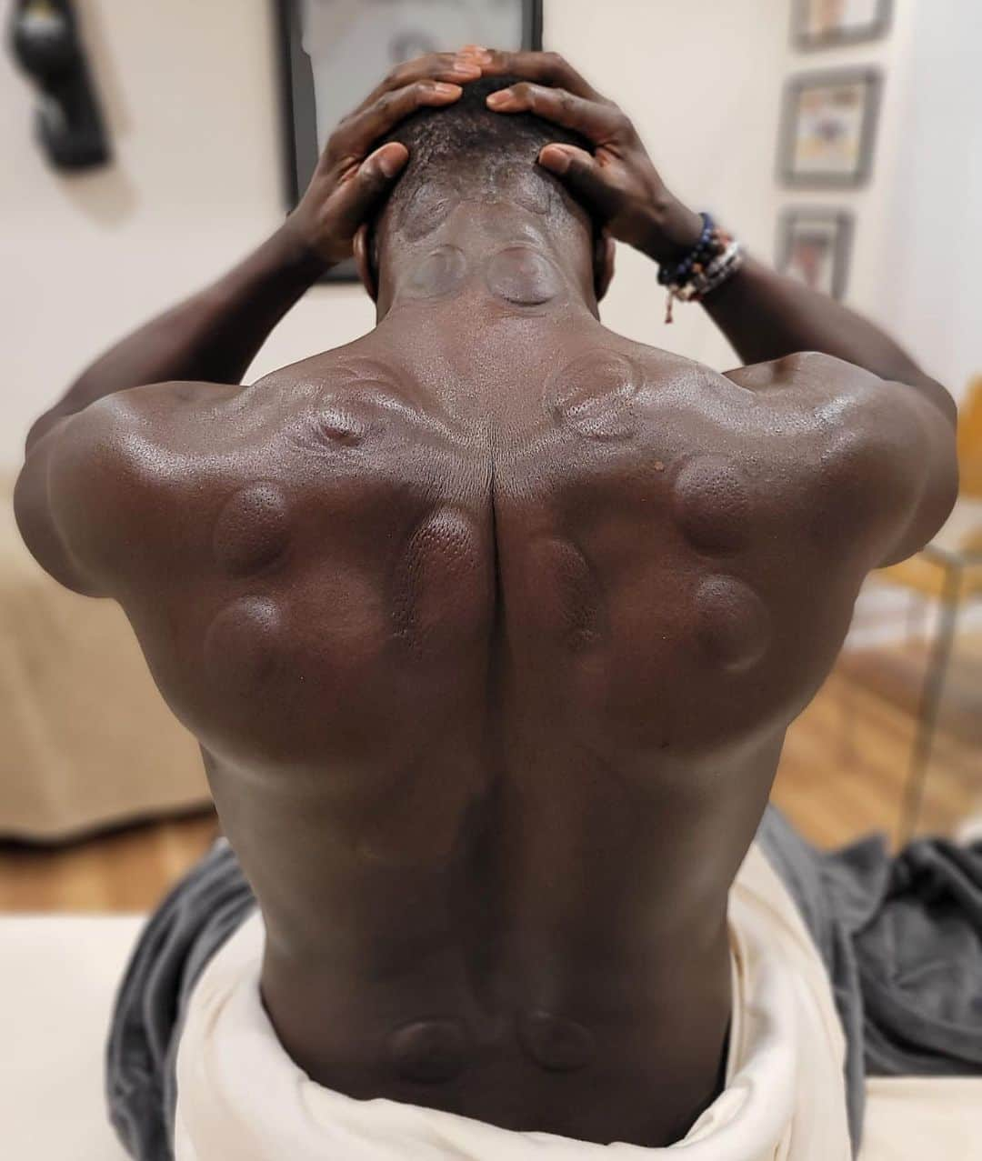 バカリ・サニャのインスタグラム：「Do you know about cupping’s benefits on the body ...   ▪️it releases muscle tensions  ▪️it increases blood and lymphatic circulation ▪️it eliminates muscle tissues adherences   Treatments by : @mkinesitherapy #montreal #health #selfcare #cuppingtherapy」