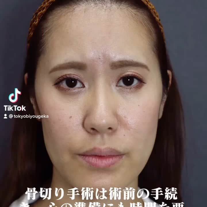 東京美容外科公式のインスタグラム：「骨切り（OGS）手術2日目検診。口の開け閉め確認の動画です。骨のご手術は術前の治療準備、患者様の心の準備、そして術後の痛みや腫れなどダウンタイム中は生活にも支障がございます。納得がいくまで何度もご相談頂き手術当日は万全の体制でお迎えしております。大きな手術ではありますが、お悩みの方は最初は難しく考えずお気軽にご相談からスタートしてください☺️  . . . 📞お問い合わせはこちら💁🏼‍♀️ 詳しくはプロフィールのURLから公式サイトへ. ▼フリーダイヤル 0120-658-958 （コールセンター受付時間：9：00～21：00） ▼LINE予約 @ tkc110 ========================= #東京美容外科#美容整形#整形#美活#美容#美容外科#特別外来#他院修正#鼻#豊胸#鼻中隔延長#新規開院#エイジング#美白#美肌#鼻#韓国#横浜#沖縄#福岡#オンライン#輪郭形成#院長#求人」