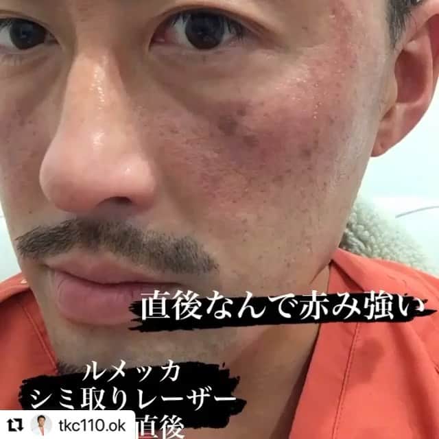 東京美容外科公式のインスタグラム：「名古屋院院長のシミ取りルメッカ🤗✨ #Repost @tkc110.ok with @make_repost ・・・ 歳を重ねるにつれてどんどん増えてく、かつ濃くなるシミ。。  今まで紫外線を無視してむしろ日焼けまでしていたので肌にはそれに伴ってシミが多数散在してました。  この冬の期間を利用してシミ取りにトライしました😊  どーです？ 施術1週間でこんなに綺麗になりました✨  実際の体験談としては痛みはゴムを引っ張って当てたような軽い痛み。 施術後30分程度は赤みがあり、じんわりとした痛みあり。2時間も経過すればほぼ痛みはなく、シミはさらに濃くなり、分離してきている状態。 1週間後にはシミはかさぶたみたいに剥がれてスッキリとした肌に若返りました✨  ぜひご参考に！！  #東京美容外科#名古屋院#錦#栄#名駅#北新地#梅田#輪郭#輪郭形成#鼻形成#鼻中隔延長 #鼻尖形成 #小鼻縮小#豊胸#シミ取り#ルメッカ#二重#埋没#他院修正」